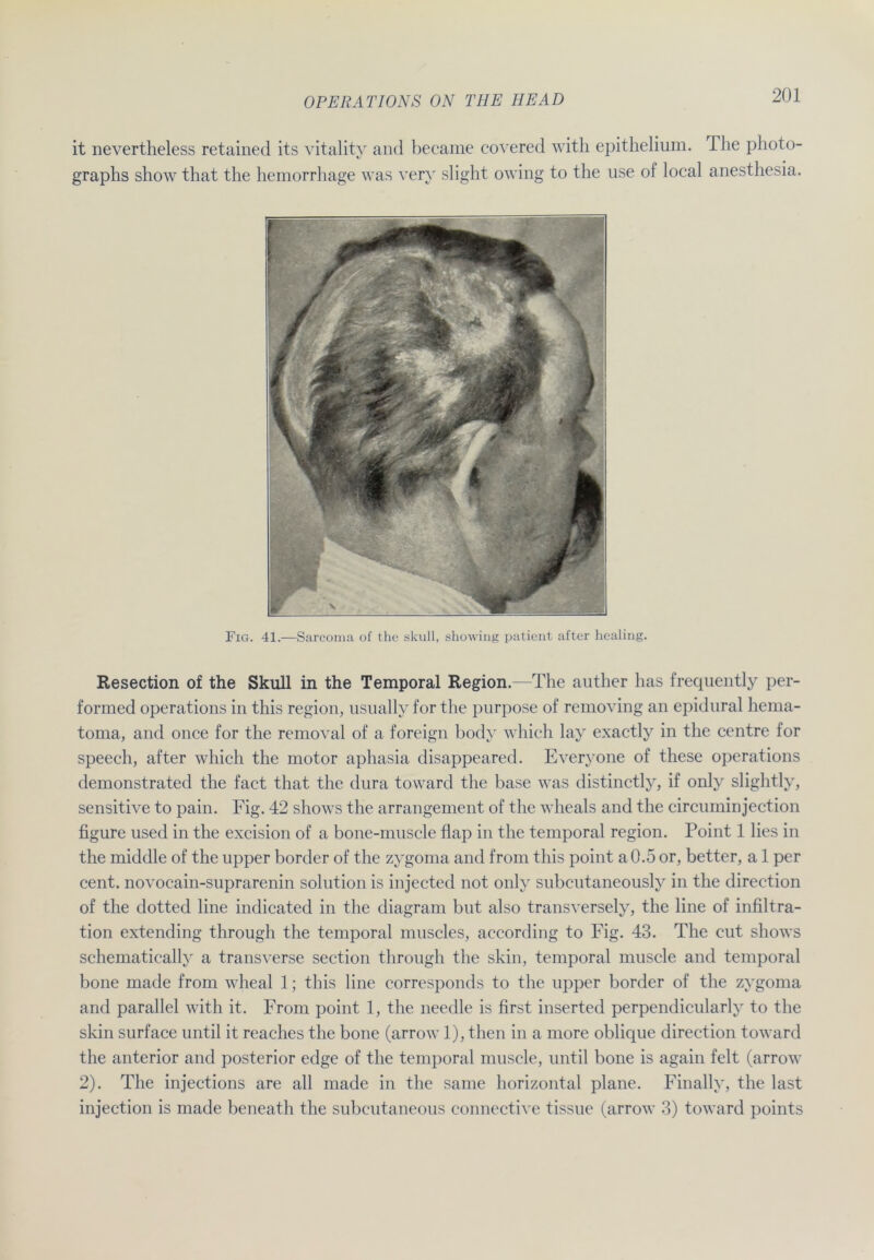 it nevertheless retained its vitality and became covered with epithelium. The plioto- graphs show that the hemorrhage was very slight owing to the use of local anesthesia. Resection of the Skull in the Temporal Region.—The auther has frequently per- formed operations in this region, usually for the pnrpose of removing an epidural hema- toma, and once for the removal of a foreign body which lay exactlv in the centre for speech, after which the motor aphasia disappeared. Everyone of these operations demonstrated the fact that the dura toward the base was distinctly, if only slightly, sensitive to pain. Fig. 42 shows the arrangement of the wheals and the circuminjection figure used in the excision of a bone-mnscle flap in the temporal region. Point 1 lies in the middle of the upper border of the zygoma and from this point a0.5 or, better, a 1 per cent. novocain-suprarenin solution is injected not only subcutaneously in the direction of the dotted line indicated in the diagram but also transversely, the line of Infiltra- tion extending through the temporal muscles, according to Fig. 43. The cut shows schematically a transverse section through the skin, temporal muscle and temporal bone made from wheal 1; this line corresponds to the upper border of the zygoma and parallel with it. From point 1, the needle is first inserted perpendicularly to the skin surface until it reaches the bone (arrow 1), then in a more oblique direction toward the anterior and posterior edge of the temporal muscle, until bone is again feit (arrow 2). The injections are all made in the same horizontal plane. Finally, the last injection is made beneath the subcutaneous connective tissue (arrow 3) toward points Fig. 41.—Sarcoma of the skull, showing patient after healing.