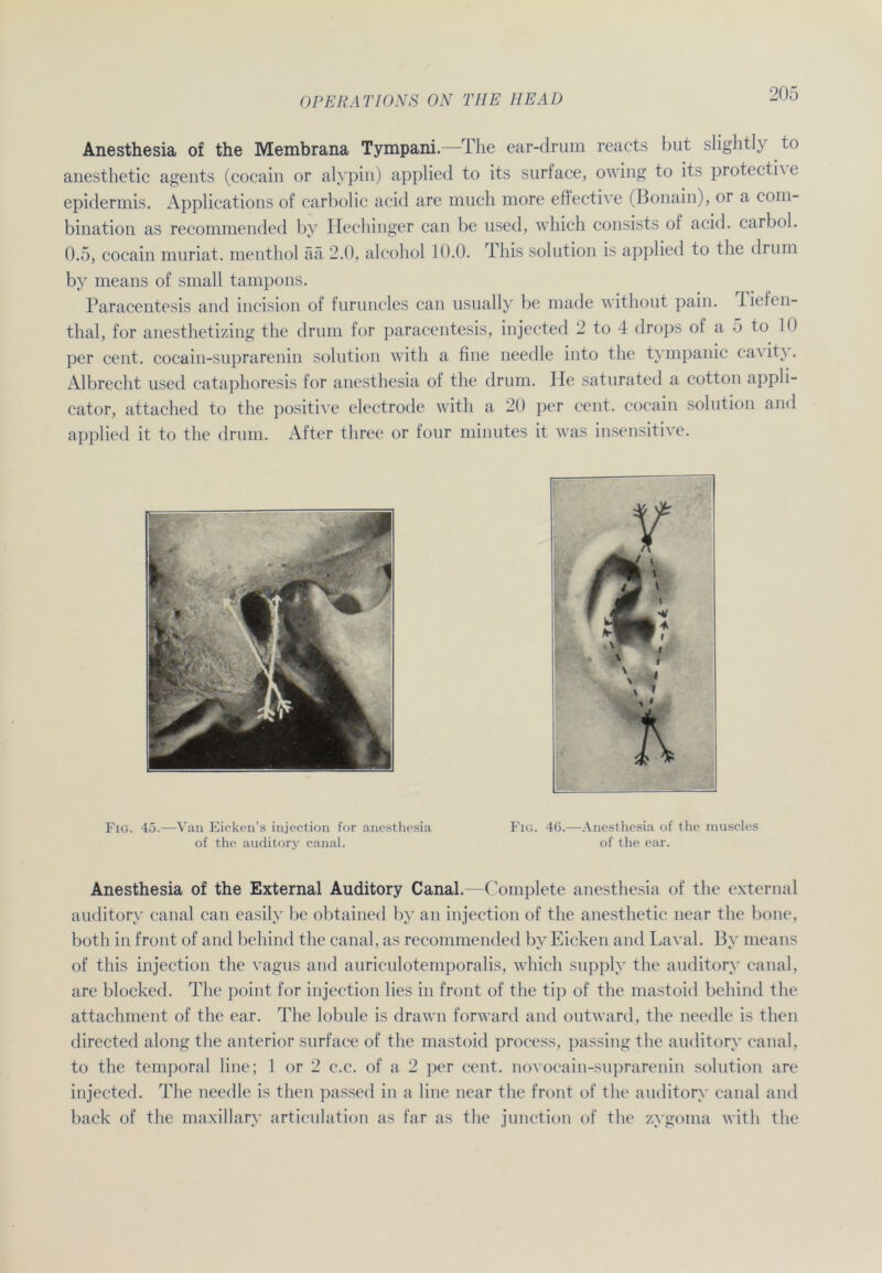 Anesthesia of the Membrana Tympani.—-The ear-drum reacts but slighth to anesthetic agents (cocain or alypin) applied to its surface, owing to its protectix e epidermis. Applications of carbolic acid are much more effective (Bonain), or a coni- bination as recommended by Hechinger can be used, which consists of acid. carbol. 0.5, cocain mnriat. menthol ää 2.0, alcohol 10.0. This solution is applied to the drum by means of small tampons. Paracentesis and incision of furuncles can usually be made without pain. 1 iefen- thal, for anesthetizing the drum for paracentesis, injected 2 to 4 drops of a 5 to 10 per cent. cocain-suprarenin solution with a fine needle into the tympanic ca\ itx. Albrecht used cataphoresis for anesthesia of the drum. He saturated a cotton appli- cator, attached to the positive electrode with a 20 per cent. cocain solution and applied it to the drum. After three or four minutes it was insensitive. Fig. 45.—Van Eicken’s injection for anesthesia of the auditory canal. Fig. 46.—Anesthesia of the muscles of the ear. Anesthesia of the External Auditory Canal.—Complete anesthesia of the external auditory canal can easily be obtained by an injection of the anesthetic near the bone, both in front of and behind the canal , as recommended by Eicken and Laval. By means of this injection the vagus and auriculotemporalis, which supplv the auditory canal, are blocked. The point for injection lies in front of the tip of the mastoid behind the attachment of the ear. The lobule is drawn forward and outward, the needle is then directed along the anterior surface of the mastoid process, passing the auditory canal, to the temporal line; 1 or 2 c.c. of a 2 per cent. novocain-suprarenin solution are injected. The needle is then passed in a line near the front of the auditory canal and back of the maxillarv articulation as far as the junction of the zygoma with the