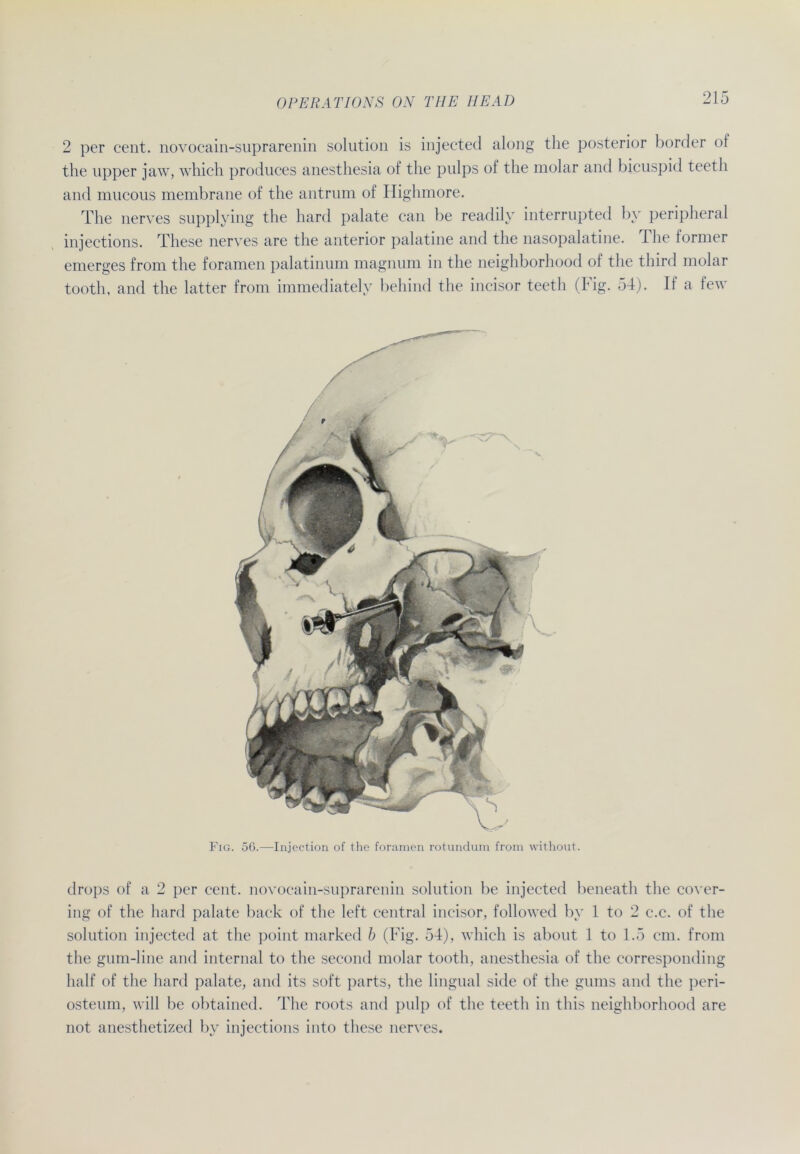 2 per cent. novocain-suprarenin solution is injected along the posterior border of the upper jaw, which produces anesthesia of the pulps of the molar and bicuspid teeth and mucous membrane of the antrum of Highmore. The nerves supplying the hard palate can be readily interrupted bv peripheral injections. These nerves are the anterior palatine and the nasopalatine. The former emerges from the foramen palatinum magnum in the neighborhood of the third molar tooth, and the latter from immediately behind the incisor teeth (big. 54). If a lew Fig. 56.—Injection of the foramen rotundum from without. drops of a 2 per cent. novocain-suprarenin solution be injected beneath the cover- ing of the hard palate back of the left central incisor, followed by 1 to 2 c.c. of the solution injected at the point marked b (Fig. 54), which is about 1 to 1.5 cm. from the gum-line and internal to the second molar tooth, anesthesia of the corresponding half of the hard palate, and its soft parts, the lingual side of the gums and the peri- osteum, will be obtained. The roots and pulp of the teeth in this neighborhood are not anesthetized by injections into these nerves.