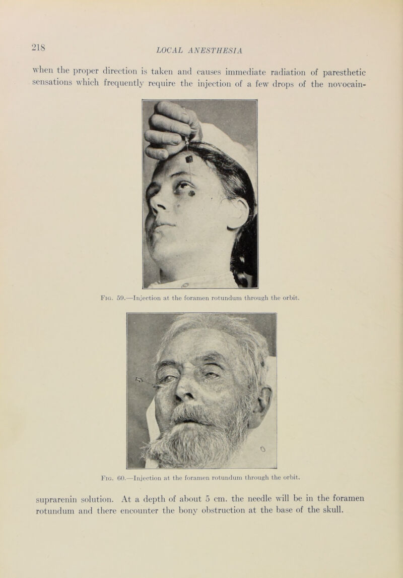 when the proper direction is taken and causes immediate radiation of paresthetic sensations which frequently recpiire the injection of a few drops of the novocain- Fig. 59.—Injection at tlie foramen rotundum through the orbit. Fig. 60.—Injection at the foramen rotundum through the orbit. suprarenin solution. At a depth of about 5 cm. the needle will be in the foramen rotundum and there encounter the bonv obstruction at the base of the skull.