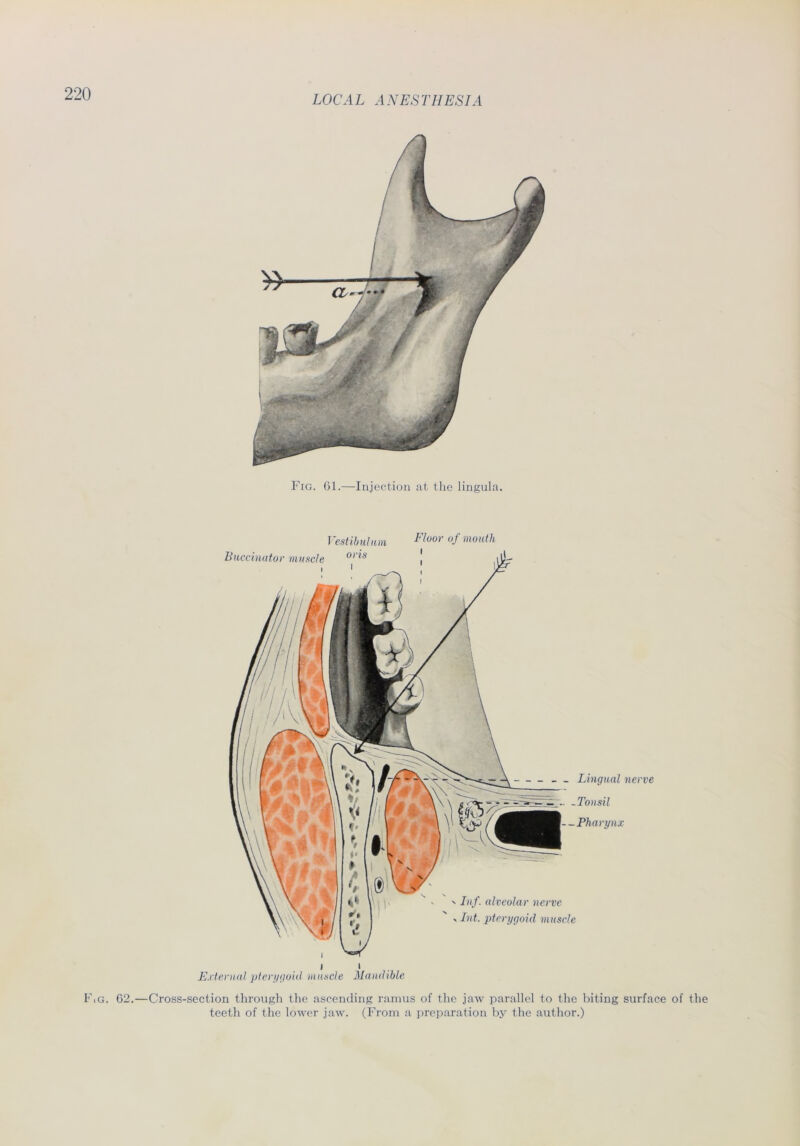 Fig. 61.—Injection at the lingula. I estibulwn Buccinator muscle or*s . i Fluor of mouth i External pterygoid mancle Mandible ' Inf. alveolar nerve ' Int. pterygoid muscle Fig. 62.—Cross-section through the ascending ramus of the jaw parallel to the biting surface of the teeth of the lower jaw. (From a preparation by the author.)