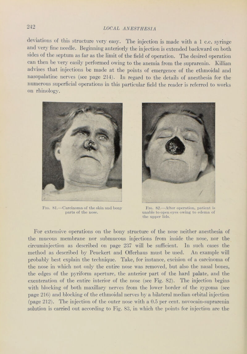 deviations of tliis structure very easy. The injection is made with a 1 c.c. syringe and very fine needle. Beginning anteriorly the injection is extended backward on both sides of the septum as far as the limit of the field of Operation. The desired Operation can then be very easily performed owing to the anemia from the suprarenin. Killian advises that injections be made at the points of emergence of the ethmoidal and nasopalatine nerves (see page 214). In regard to the details of anesthesia for the numerous superficial operations in this particular field the reader is referred to works on rhinologv. Oi Fig. 81.—Carcinoma of the skin and bony parts of the nose. Fig. 82.—After Operation, patient is unable to open eyes owing to edema of the upper lids. For extensive operations on the bony structure of the nose neither anesthesia of the mucous membrane nor submucous injections front inside the nose, nor the circuminjection as described on page 237 will be sufficient. In such cases the method as described by Peuckert and Offerhaus must be used. An example will probably best explain the technique. Take, for instance, excision of a carcinoma of the nose in which not only the entire nose was removed, but also the nasal bones, the edges of the pyriform aperture, the anterior part of the hard palate, and the exenteration of the entire interior of the nose (see Fig. 82). The injection begins with blocking of both maxillary nerves from the lower border of the zygoma (see page 21G) and blocking of the ethmoidal nerves by a bilateral median orbital injection (page 212). The injection of the outer nose with a 0.5 per cent. novocain-suprarenin solution is carried out according to Fig. 83, in which the points for injection are the