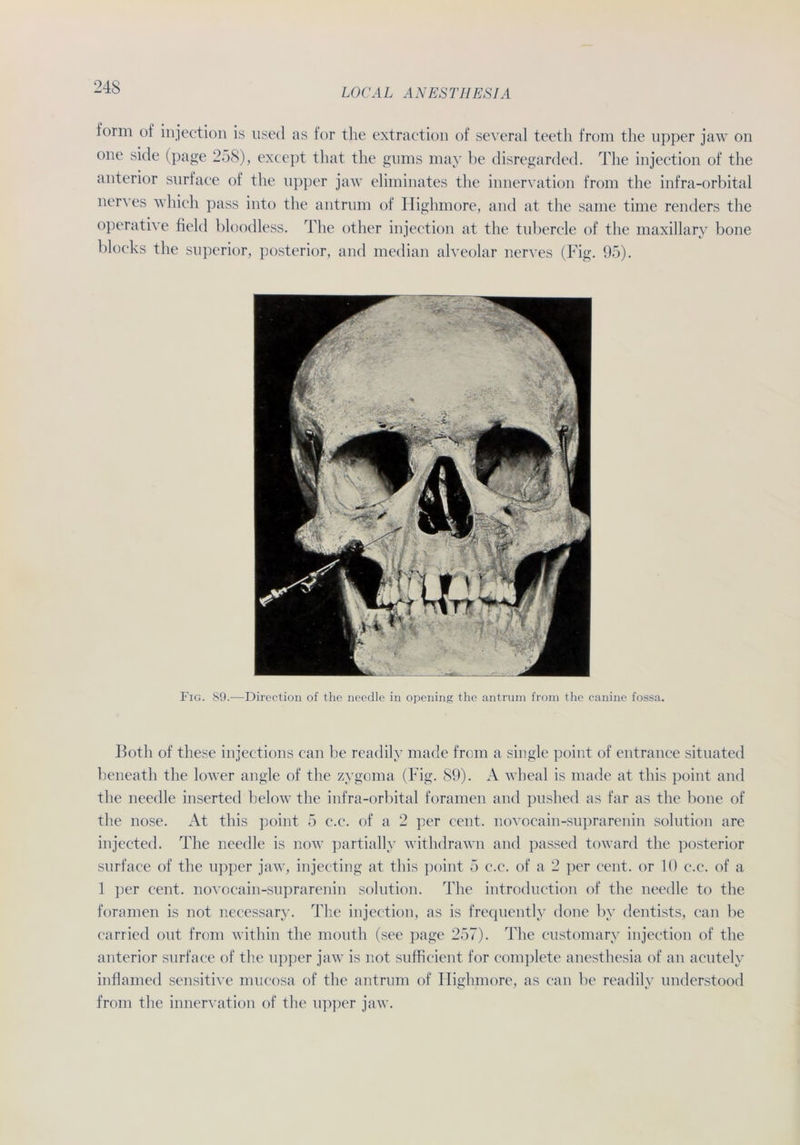 form of injection is used as for the extraction of several teeth from the upper jaw on one side (page 258), except that the gums may be disregarded. The injection of the anterior surface of the upper jaw eliminates the innervation from the infra-orbital nerves which pass into the antrum of Highmore, and at the same time renders the operative field bloodless. The other injection at the tubercle of the maxillarv bone bloeks the superior, posterior, and median alveolar nerves (Fig. 95). Fig. S9.—Dircction of the needle in opening the antrum from the canine fossa. Both of these injections can be readily made from a single point of entrance situated beneath the lower angle of the zygoma (Fig. 89). A wheal is made at this point and the needle inserted below the infra-orbital foramen and pushed as far as the bone of the nose. At this point 5 c.c. of a 2 per cent. novocain-suprarenin solution are injected. The needle is now partiallv withdrawn and passed toward the posterior surface of the upper jaw, injecting at this point 5 c.c. of a 2 per cent. or 10 c.c. of a 1 per cent. novocain-suprarenin solution. The introduction of the needle to the foramen is not necessary. The injection, as is frequently done by dentists, can be carried out from within the mouth (see page 257). The customary injection of the anterior surface of the upper jaw is not sufficient for complete anesthesia of an acutely inflamed sensitive mucosa of the antrum of Highmore, as can be readily understood from the innervation of the upper jaw.