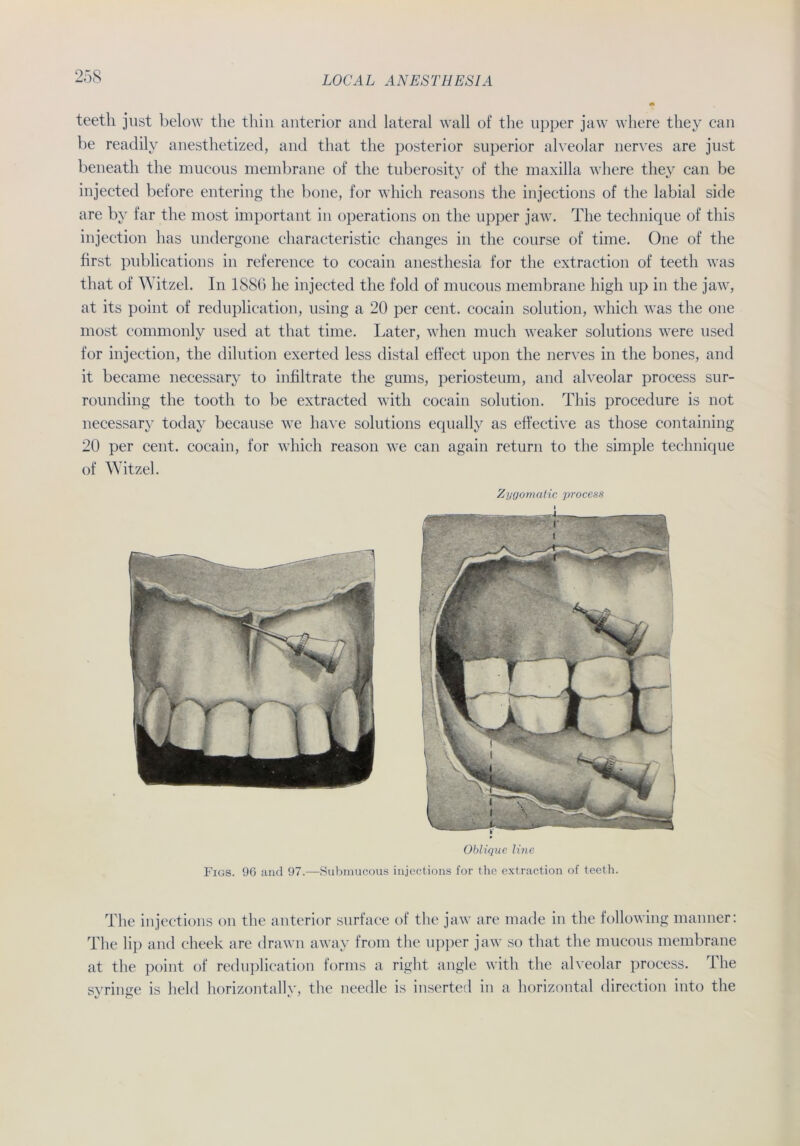 teetli just below the thin anterior and lateral wall of the upper jaw where they can be readily anesthetized, and that the posterior superior alveolar nerves are just beneath the mucous membrane of the tuberosity of the maxilla where they can be injected before entering the hone, for which reasons the injections of the labial side are by far the most important in operations on the upper jaw. The technique of this injection has undergone characteristic changes in the course of time. One of the first publications in reference to cocain anesthesia for the extraction of teeth was that of Witzei. In 1886 he injected the fold of mucous membrane high up in the jaw, at its point of reduplication, using a 20 per cent. cocain solution, which was the one most connnonlv used at that time. Later, when much weaker Solutions were used for injection, the dilution exerted less distal effect upon the nerves in the bones, and it became necessary to infiltrate the gums, periosteum, and alveolar process sur- rounding the tooth to be extracted with cocain solution. This procedure is not necessary today because we have Solutions equally as effective as those containing 20 per cent. cocain, for which reason we can again return to the simple technique of Witzei. Zygomatic process Oblique line Figs. 96 and 97.—Submucous injections for the extraction of teeth. The injections on the anterior surface of the jaw are made in the following manner: The lip and cheek are drawn away from the upper jaw so that the mucous membrane at the point of reduplication forms a right angle with the alveolar process. The syringe is held horizontally, the needle is inserted in a horizontal direction into the