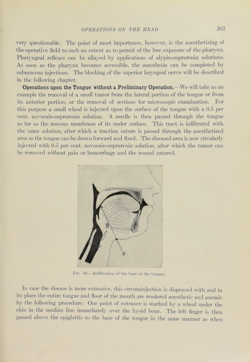 very questionable. The point of most importance, however, is the anesthetizing of the operative fiele! to such an extent as to permit of the free exposure of the pharynx. Pharyngeal reflexes can be allayed by applications of alypin-suprarenin Solutions. As soon as the pharynx beeomes accessible, the anesthesia can be completed by submucous injections. The blocking of the superior larvngeal nerve will be described in the following chapter. Operations upon the Tongue without a Preliminary Operation.—AYe will take as an example the removal of a small tumor from the lateral portion of the tongue or from its anterior portion, or the removal of sections for microscopic examination. For this purpose a small wheal is injected upon the surface of the tongue with a 0.5 per cent. novocain-suprarenin solution. A needle is then passed through the tongue as far as the mucous membrane of its under surface. This tract is infiltrated with the same solution, after whicli a traction suture is passed through the anesthetized area so the tongue can be drawn forward and fixed. The diseased area is now circularly injected with 0.5 per cent. novocain-suprarenin solution, after which the tumor can be removed without pain or hemorrhage and the wound sutured. Fig. 98.—Infiltration of the base of the tongue. In case the disease is more extensive, this circuminjection is dispensed with and in its place the entire tongue and floor of the mouth are rendered anesthetic and anemic by the following procedure: One point of entrance is marked by a wheal under the chin in the median line immediately over the hvoid hone. The left finger is then passed above the epiglottis to the base of the tongue in the same manner as when