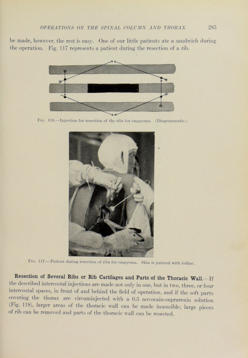 be made, however, the rest is easy. One of our little patients ate a Sandwich during Fig. 117. Patient during resection of ribs for empyema. Skin is painted with iodine. Resection of Several Ribs or Rib Cartilages and Parts of the Thoracic Wall. If the described intercostal injections are made not only in one, but in two, three, or four intercostal spaces, in front of and behind the field of Operation, and if the soft parts covering the thorax are circuminjected with a 0.5 novocain-suprarenin solution (I ig. 118), larger areas ol the thoracic wall can be made insensible; large pieces of rib can be remoted and parts of the thoracic wall can be resected.