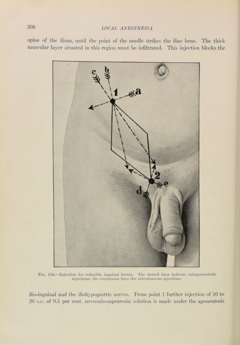 spine of the ilium, until the point of the needle strikes the iliac bone. The tliick muscular layer situated in this region must be infiltrated. This injection blocks the Fig. 134.—Injection for reducible inguinal hernia. The dotted lines indicate subaponeurotic injections, the continuous lines the subcutaneous injections. ilio-inguinal and the iliohypogastric nerves. From point 1 further injection of 10 to 20 c.c. of 0.5 per cent. novocain-suprarenin solution is made linder the aponeurosis