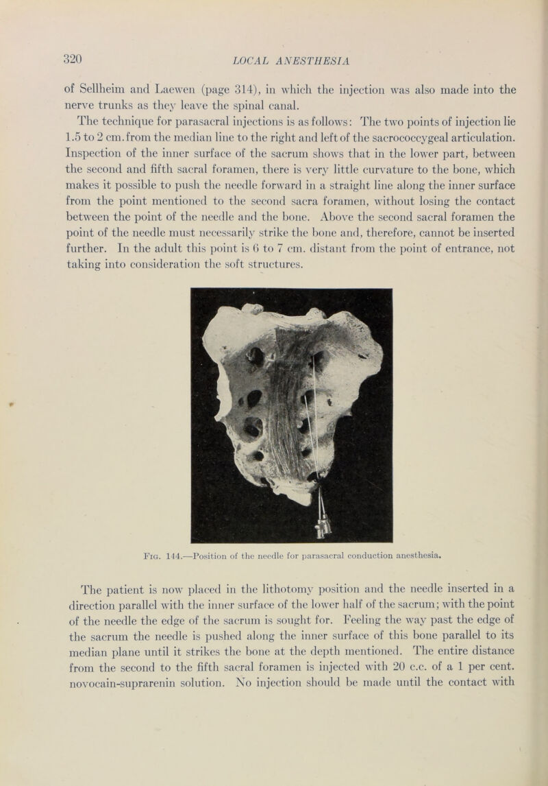 of Sellheim and Laewen (page 314), in which the injection was also made into the nerve trunks as they leave the spinal canal. The technique for parasacral injections is as follows : The two points of injection lie 1.5 to 2 cm.from the median line to the right and left of the sacrococcygeal articulation. Inspection of the inner surface of the sacrum shows that in the lower part, between the second and fiftli sacral foramen, there is very little curvature to the bone, which makes it possible to push the needle forward in a straight line along the inner surface from the point mentioned to the second sacra foramen, without losing the contact between the point of the needle and the bone. iVbove the second sacral foramen the point of the needle must necessarily strike the bone and, therefore, cannot be inserted further. In the adult this point is 6 to 7 cm. distant from the point of entrance, not taking into consideration the soft structures. Fig. 144.—Position of the needle for parasacral conduction anesthesia. The patient is now placed in the lithotomy position and the needle inserted in a direction parallel with the inner surface of the lower half of the sacrum; with the point of the needle the edge of the sacrum is sought for. Feeling the way past the edge of the sacrum the needle is pushed along the inner surface of this bone parallel to its median plane until it strikes the bone at. the depth mentioned. The entire distance from the second to the fiftli sacral foramen is injected with 20 c.c. of a 1 per cent. novocain-suprarenin solution. No injection shonld be made until the contact with l