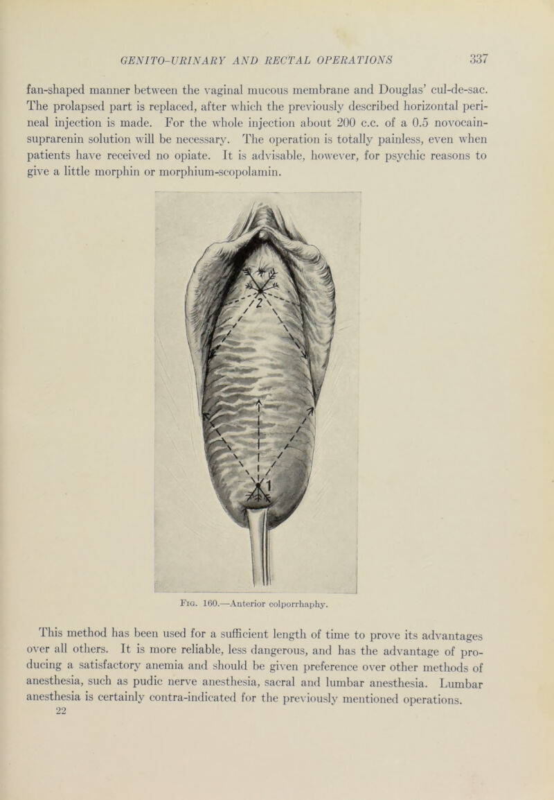 fan-shaped manner between the vaginal mucous membrane and Douglas’ cul-de-sac. The prolapsed part is replaced, after which the previously described horizontal peri- neal injection is made. For the whole injection about 200 c.c. of a 0.5 novocain- suprarenin solution will be necessary. The Operation is totally painless, even when patients have received no opiate. It is advisable, however, for psychic reasons to give a little morpliin or morphium-scopolamin. Fig. 160.—Anterior colporrhaphy. lhis method has beeil used for a sufficient length of time to prove its advantages over all others. It is more reliable, less dangerous, and has the advantage of pro- ducing a satisfactory anemia and should be given preference over other methods of anesthesia, such as pudic nerve anesthesia, sacral and lumbar anesthesia. Lumbar anesthesia is certainly contra-indicated for the previously mentioned operations. 22