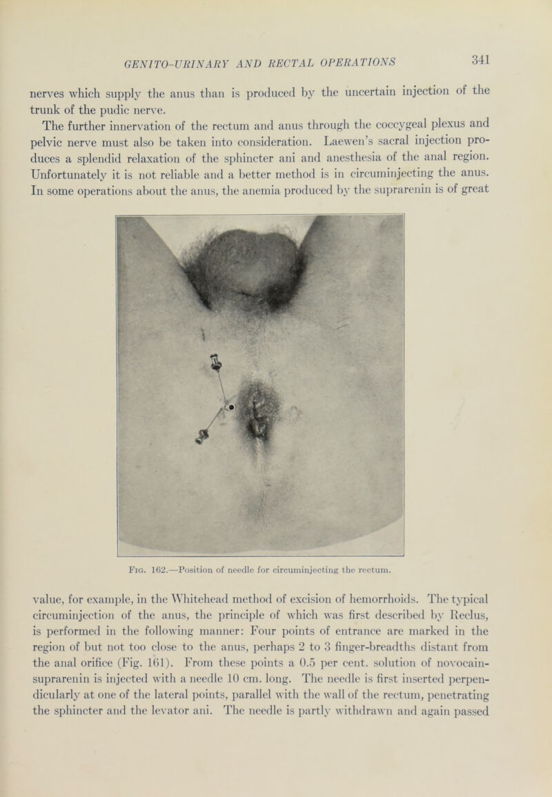 nerves which supply the anus than is produced by the uncertain injection of the trunk of the pudic nerve. The further innervation of the rectum and anus through the coccygeal plexus and pelvic nerve must also be taken into consideration. Laewen’s sacral injection pro- duces a splendid relaxation of the sphincter ani and anesthesia of the anal region. Unfortunately it is not reliable and a better method is in circuminjecting the anus. In some operations about the anus, the anemia produced by the suprarenin is of great Fig. 162.—Position of needle for circuminjecting the rectum. value, for example, in the Whitehead method of excision of hemorrhoids. The typical circuminjection of the anus, the principle of which was first described by Reclus, is performed in the following manner: Four points of entrance are marked in the region of but not too close to the anus, perhaps 2 to 3 finger-breadths distant from the anal orifice (Fig. 161). From these points a 0.5 per cent. solution of novocain- suprarenin is injected with a needle 10 cm. long. The needle is first inserted perpen- dicularly at one of the lateral points, parallel with the wall of the rectum, penetrating the sphincter and the levator ani. The needle is partly withdrawn and again passed