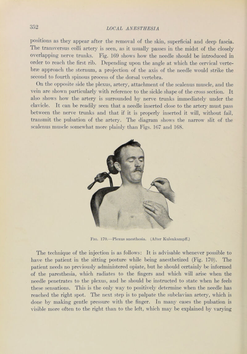 positions as they appear after the removal of the skin, superficial and deep fascia. The transversus colli artery is seen, as it usually passes in the midst of the closely overlapping nerve trunks. Fig. 169 shows how the needle should be introduced in Order to reach the first rib. Depending upon the angle at which the cervical verte- brse approach the sternum, a projection of the axis of the needle would strike the second to fourtli spinous process of the dorsal vertebra. On the opposite side the plexus, artery, attachment of the scalenus muscle, and the vein are shown particularly with reference to the sickle shape of the cross section. It also shows how the artery is surrounded by nerve trunks immediately under the clavicle. It can be readily seen that a needle inserted close to the artery must pass between the nerve trunks and that if it is properly inserted it will, without fail, transmit the pulsation of the artery. The diagram shows the narrow slit of the scalenus muscle somewhat more plainly than Figs. 167 and 168. Fig. 170.—Plexus anesthesia. (After Kulenkampff.) The technique of the injection is as follows: It is advisable whenever possible to have the patient in the sitting posture wliile being anesthetized (Fig. 170). The patient needs no previously administered opiate, but he should certainly be informed of the paresthesia, which radiates to the fingers and which will arise wlien the needle penetrates to the plexus, and he should be instructed to state when he feels these sensations. This is the only way to positively determine when the needle has reac-hed the right spot. The next step is to palpate the subclavian artery, which is done by making gentle pressure with the finger. In many cases the pulsation is visible more offen to the right than to the left, which may be explained by varying