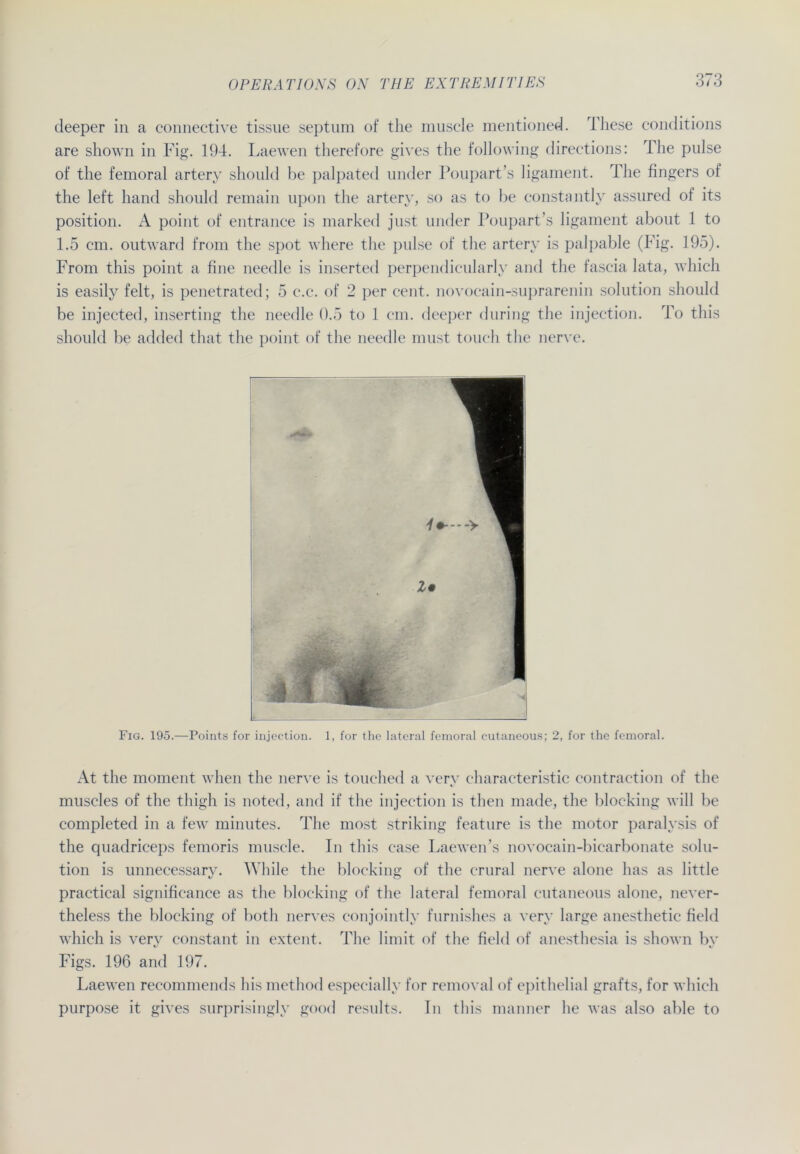 deeper in a connective tissue septum of the muscle mentioned. These conditions are shown in Fig. 194. Laewen therefore gives the following directions: The pulse of the femoral artery should be palpated linder Poupart’s ligament. The fingers of the left hand should remain upon the artery, so as to be constantly assured of its Position. A point of entrance is marked just under Poupart’s ligament about 1 to 1.5 cm. outward from the spot where the pulse of the artery is palpable (Fig. 195). From this point a fine needle is inserted perpendicularly and the fascia lata, which is easily feit, is penetrated; 5 c.c. of 2 per cent. novocain-suprarenin solution should be injected, inserting the needle 0.5 to 1 cm. deeper during the injection. To this should be added that the point of the needle must touch the nerve. Fig. 195.—Points for injection. 1, for the lateral femoral cutaneous; 2, for the femoral. At the moment when the nerve is touched a verv characteristic contraction of the muscles of the thigli is noted, and if the injection is then made, the blocking will be completed in a few minutes. The most striking feature is the motor paralysis of the cpiadriceps femoris muscle. In this case Laewen’s novocain-bicarbonate solu- tion is unnecessary. While the blocking of the crural nerve alone has as little practical significance as the blocking of the lateral femoral cutaneous alone, never- theless the blocking of both nerves conjointly furnishes a very large anesthetic fielet which is very constant in extent. The limit of the field of anesthesia is shown by Figs. 196 and 197. Laewen recommends his method especially for removal of epithelial grafts, for which purpose it gives surprisingly good resnlts. In this manner he was also able to