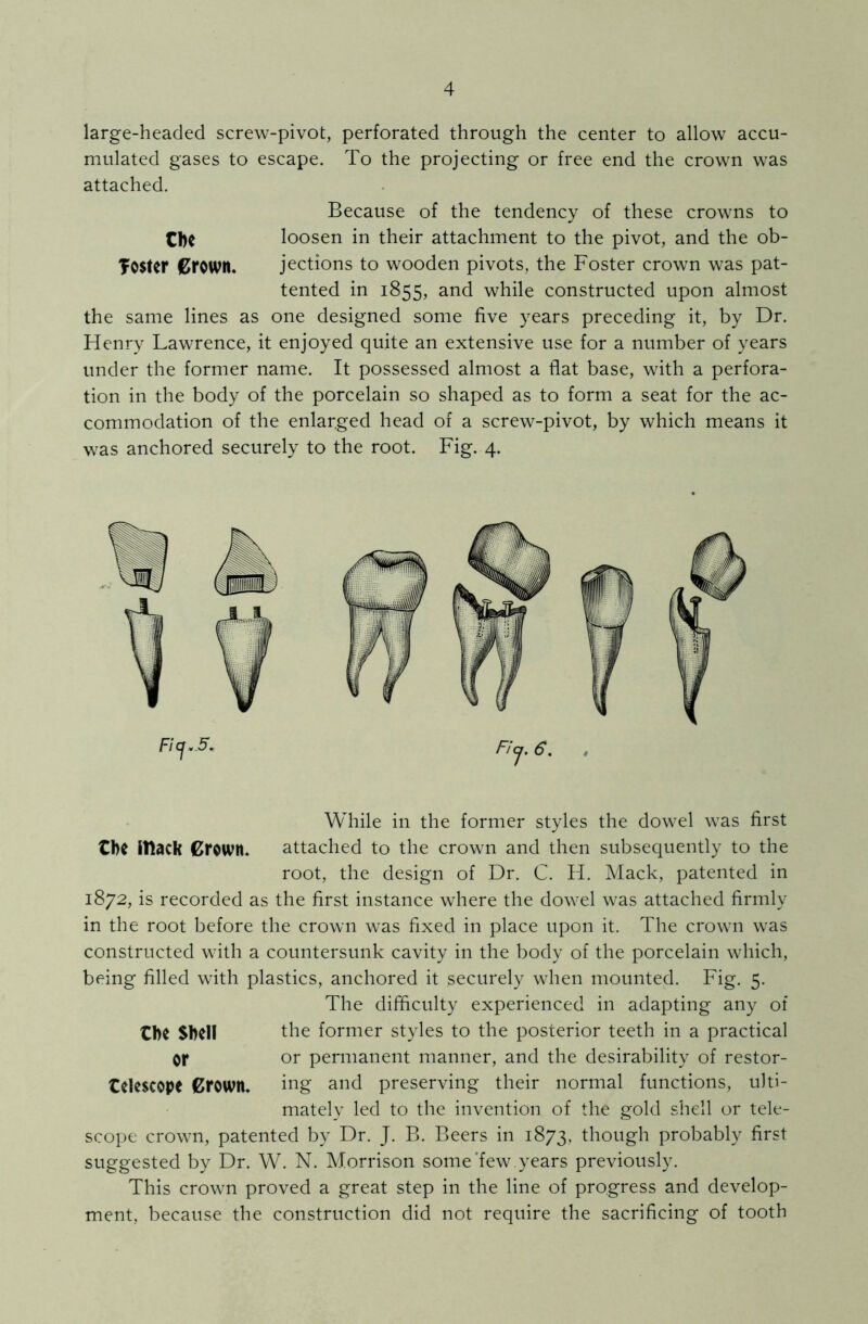 large-headed screw-pivot, perforated through the center to allow accu- mulated gases to escape. To the projecting or free end the crown was attached. Because of the tendency of these crowns to Cbe loosen in their attachment to the pivot, and the ob- Toster Grown. jections to wooden pivots, the Foster crown was pat- tented in 1855, and while constructed upon almost the same lines as one designed some five years preceding it, by Dr. Henry Lawrence, it enjoyed quite an extensive use for a number of years under the former name. It possessed almost a flat base, with a perfora- tion in the body of the porcelain so shaped as to form a seat for the ac- commodation of the enlarged head of a screw-pivot, by which means it was anchored securely to the root. Fig. 4. While in the former styles the dowel was first the iltack Crown. attached to the crown and then subsequently to the root, the design of Dr. C. H. Mack, patented in 1872, is recorded as the first instance where the dowel was attached firmly in the root before the crown was fixed in place upon it. The crown was constructed with a countersunk cavity in the body of the porcelain which, being filled with plastics, anchored it securely when mounted. Fig. 5. The difficulty experienced in adapting any of the Shell the former styles to the posterior teeth in a practical Or or permanent manner, and the desirability of restor- telescope Crown. ing and preserving their normal functions, ulti- mately led to the invention of the gold shell or tele- scope crown, patented by Dr. J. B. Beers in 1873, though probably first suggested by Dr. W. N. Morrison some'few. years previously. This crown proved a great step in the line of progress and develop- ment, because the construction did not require the sacrificing of tooth