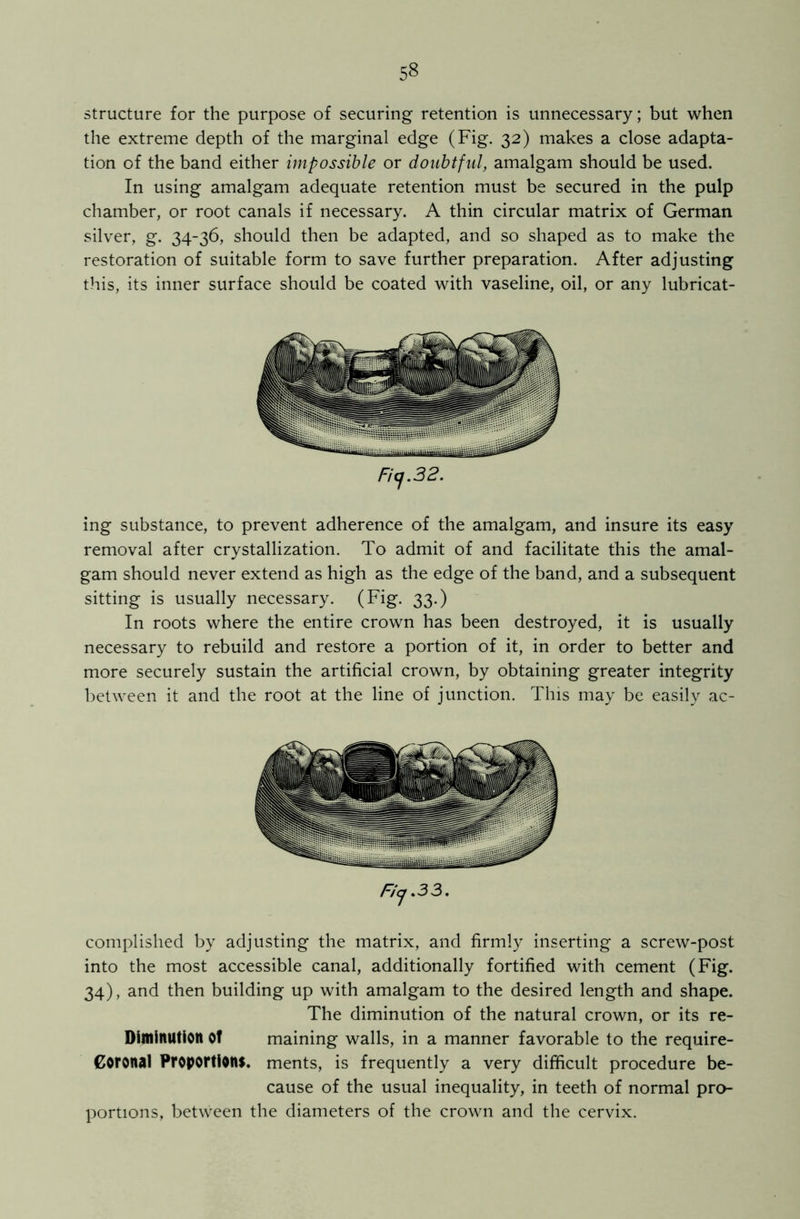 structure for the purpose of securing retention is unnecessary; but when the extreme depth of the marginal edge (Fig. 32) makes a close adapta- tion of the band either impossible or doubtful, amalgam should be used. In using amalgam adequate retention must be secured in the pulp chamber, or root canals if necessary. A thin circular matrix of German silver, g. 34-36, should then be adapted, and so shaped as to make the restoration of suitable form to save further preparation. After adjusting this, its inner surface should be coated with vaseline, oil, or any lubricat- Ficj.32. ing substance, to prevent adherence of the amalgam, and insure its easy removal after crystallization. To admit of and facilitate this the amal- gam should never extend as high as the edge of the band, and a subsequent sitting is usually necessary. (Fig. 33.) In roots where the entire crown has been destroyed, it is usually necessary to rebuild and restore a portion of it, in order to better and more securely sustain the artificial crown, by obtaining greater integrity between it and the root at the line of junction. This may be easily ac- Ficj .33, complished by adjusting the matrix, and firmly inserting a screw-post into the most accessible canal, additionally fortified with cement (Fig. 34), and then building up with amalgam to the desired length and shape. The diminution of the natural crown, or its re- Diminution of maining walls, in a manner favorable to the require- Goronal Proportions, ments, is frequently a very difficult procedure be- cause of the usual inequality, in teeth of normal pro- portions, between the diameters of the crown and the cervix.