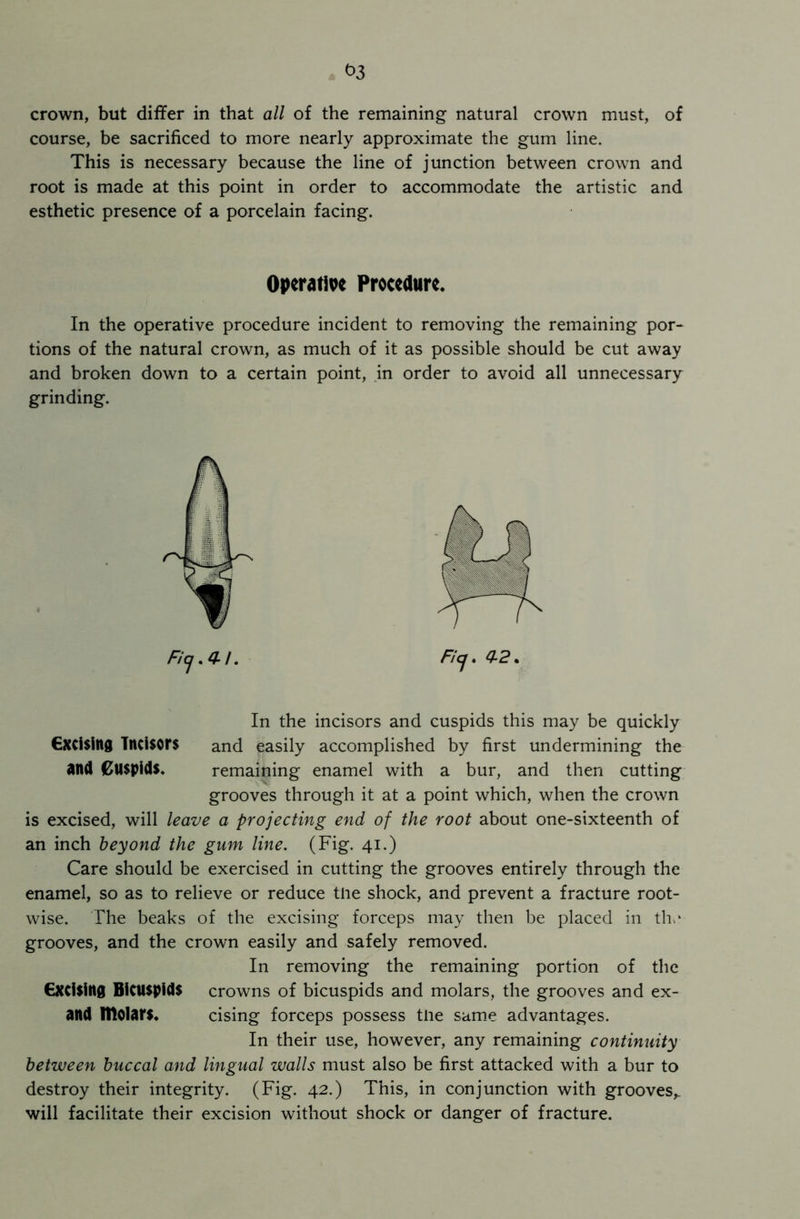 crown, but differ in that all of the remaining natural crown must, of course, be sacrificed to more nearly approximate the gum line. This is necessary because the line of junction between crown and root is made at this point in order to accommodate the artistic and esthetic presence of a porcelain facing. Operative Procedure. In the operative procedure incident to removing the remaining por- tions of the natural crown, as much of it as possible should be cut away and broken down to a certain point, in order to avoid all unnecessary grinding. Ficf.4/. Fief, 0-2. In the incisors and cuspids this may be quickly Excising Tncisors and easily accomplished by first undermining the and Cuspids. remaining enamel with a bur, and then cutting grooves through it at a point which, when the crown is excised, will leave a projecting end of the root about one-sixteenth of an inch beyond the gum line. (Fig. 41.) Care should be exercised in cutting the grooves entirely through the enamel, so as to relieve or reduce the shock, and prevent a fracture root- wise. The beaks of the excising forceps may then be placed in the grooves, and the crown easily and safely removed. In removing the remaining portion of the excising Bicuspids crowns of bicuspids and molars, the grooves and ex- and IHolars. cising forceps possess the same advantages. In their use, however, any remaining continuity between buccal and lingual walls must also be first attacked with a bur to destroy their integrity. (Fig. 42.) This, in conjunction with grooves,, will facilitate their excision without shock or danger of fracture.