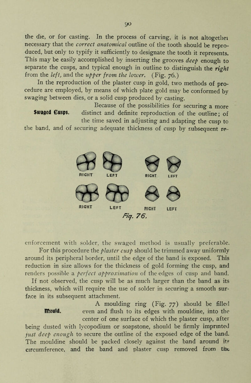 the die, or for casting. In the process of carving, it is not altogethei necessary that the correct anatomical outline of the tooth should be repro- duced, but only to typify it sufficiently to designate the tooth it represents. This may be easily accomplished by inserting the grooves deep enough to separate the cusps, and typical enough in outline to distinguish the right from the left, and the upper from the lozver. (Fig. 76.) In the reproduction of the plaster cusp in gold, two methods of pro- cedure are employed, by means of which plate gold may be conformed by swaging between dies, or a solid cusp produced by casting. Because of the possibilities for securing a more Swaged Gu$P$. distinct and definite reproduction of the outline; of the time saved in adjusting and adapting the cusp to the band, and of securing adequate thickness of cusp by subsequent re- 9 LEET 0 LEFT Ficj. 76. enforcement with solder, the swaged method is usually preferable. For this procedure the plaster cusp should be trimmed away uniformly around its peripheral border, until the edge of the band is exposed. This reduction in size allows for the thickness of gold forming the cusp, and renders possible a perfect approximation of the edges of cusp and band. If not observed, the cusp will be as much larger than the band as its thickness, which will require the use of solder in securing a smooth sur- face in its subsequent attachment. A moulding ring (Fig. 77) should be filled mould. even and flush to its edges with mouldine, into the center of one surface of which the plaster cusp, after being dusted with lycopodium or soapstone, should be firmly imprinted just deep enough to secure the outline of the exposed edge of the band. The mouldine should be packed closely against the band around it? circumference, and the band and plaster cusp removed from the lei=t RIGHT