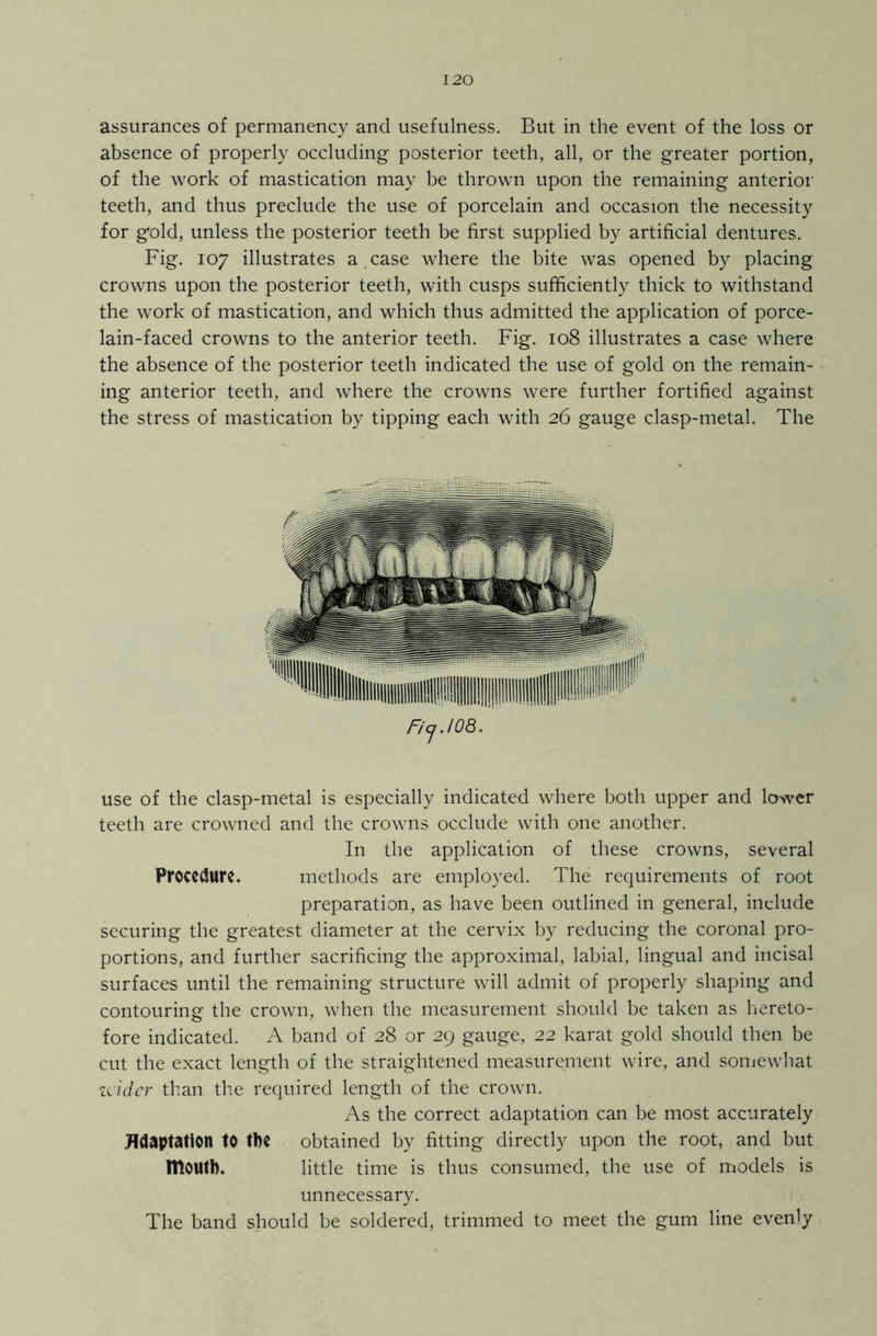 assurances of permanency and usefulness. But in the event of the loss or absence of properly occluding posterior teeth, all, or the greater portion, of the work of mastication may be thrown upon the remaining anterior teeth, and thus preclude the use of porcelain and occasion the necessity for gold, unless the posterior teeth be first supplied by artificial dentures. Fig. 107 illustrates a case where the bite was opened by placing crowns upon the posterior teeth, with cusps sufficiently thick to withstand the work of mastication, and which thus admitted the application of porce- lain-faced crowns to the anterior teeth. Fig. 108 illustrates a case where the absence of the posterior teeth indicated the use of gold on the remain- ing anterior teeth, and where the crowns were further fortified against the stress of mastication by tipping each with 26 gauge clasp-metal. The Ficj .108. use of the clasp-metal is especially indicated where both upper and lower teeth are crowned and the crowns occlude with one another. In the application of these crowns, several Procedure. methods are employed. The requirements of root preparation, as have been outlined in general, include securing the greatest diameter at the cervix by reducing the coronal pro- portions, and further sacrificing the approximal, labial, lingual and incisal surfaces until the remaining structure will admit of properly shaping and contouring the crown, when the measurement should be taken as hereto- fore indicated. A band of 28 or 29 gauge, 22 karat gold should then be cut the exact length of the straightened measurement wire, and somewhat a ider than the required length of the crown. As the correct adaptation can be most accurately Adaptation to the obtained by fitting directly upon the root, and but mouth. little time is thus consumed, the use of models is unnecessary. The band should be soldered, trimmed to meet the gum line evenly