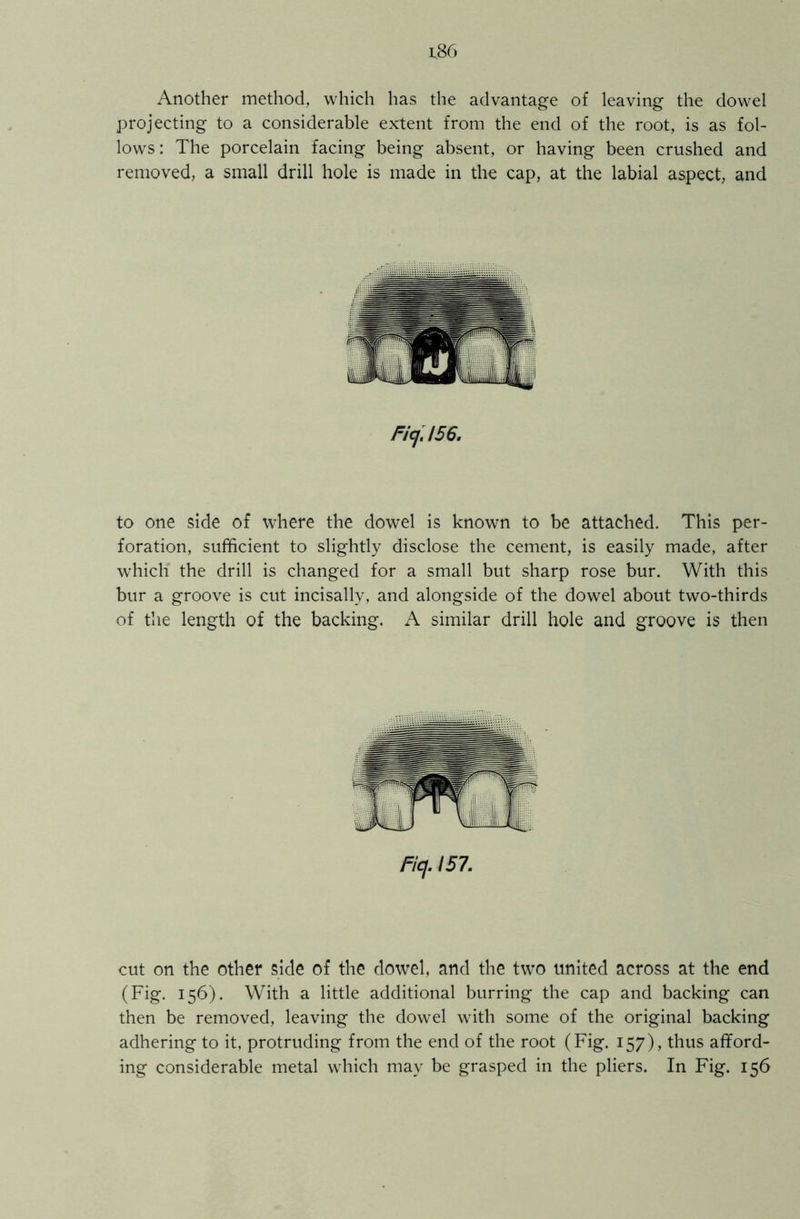 Another method, which has the advantage of leaving the dowel projecting to a considerable extent from the end of the root, is as fol- lows : The porcelain facing being absent, or having been crushed and removed, a small drill hole is made in the cap, at the labial aspect, and Ficj.156. to one side of where the dowel is known to be attached. This per- foration, sufficient to slightly disclose the cement, is easily made, after which the drill is changed for a small but sharp rose bur. With this bur a groove is cut incisally, and alongside of the dowel about two-thirds of the length of the backing. A similar drill hole and groove is then cut on the other side of the dowel, and the two united across at the end (Fig. 156). With a little additional burring the cap and backing can then be removed, leaving the dowel with some of the original backing adhering to it, protruding from the end of the root (Fig. 157), thus afford- ing considerable metal which may be grasped in the pliers. In Fig. 156