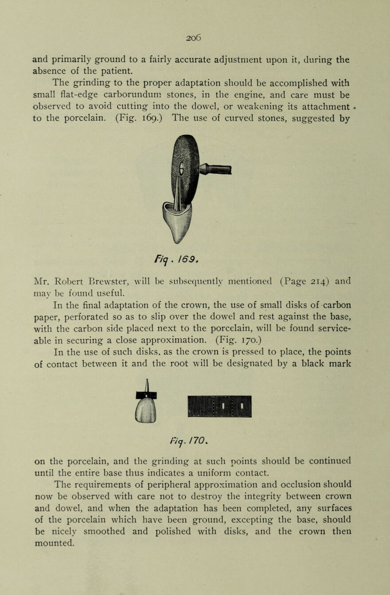 and primarily ground to a fairly accurate adjustment upon it, during the absence of the patient. The grinding to the proper adaptation should be accomplished with small flat-edge carborundum stones, in the engine, and care must be observed to avoid cutting into the dowel, or weakening its attachment • to the porcelain. (Fig. 169.) The use of curved stones, suggested by r/cj . 169. Mr. Robert Brewster, will be subsequently mentioned (Page 214) and may be found useful. In the final adaptation of the crown, the use of small disks of carbon paper, perforated so as to slip over the dowel and rest against the base, with the carbon side placed next to the porcelain, will be found service- able in securing a close approximation. (Fig. 170.) In the use of such disks, as the crown is pressed to place, the points of contact between it and the root will be designated by a black mark i-icj. no. on the porcelain, and the grinding at such points should be continued until the entire base thus indicates a uniform contact. The requirements of peripheral approximation and occlusion should now be observed with care not to destroy the integrity between crown and dowel, and when the adaptation has been completed, any surfaces of the porcelain which have been ground, excepting the base, should be nicely smoothed and polished with disks, and the crown then mounted.