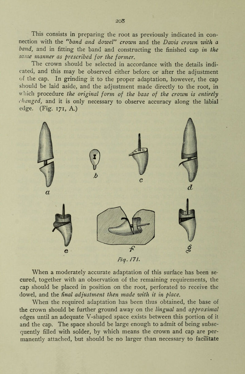 205 This consists in preparing the root as previously indicated in con- nection with the “band and dowel” crown and the Davis crown with a band, and in fitting the band and constructing the finished cap in the same manner as prescribed for the former. The crown should be selected in accordance with the details indi- cated, and this may be observed either before or after the adjustment of the cap. In grinding it to the proper adaptation, however, the cap should be laid aside, and the adjustment made directly to the root, in which procedure the original form of the base of the crown is entirely changed, and it is only necessary to observe accuracy along the labial edge. (Fig. 171, A.) Ficj. m. When a moderately accurate adaptation of this surface has been se- cured, together with an observation of the remaining requirements, the cap should be placed in position on the root, perforated to receive the dowel, and the final adjustment then made with it in place. When the required adaptation has been thus obtained, the base of the crown should be further ground away on the lingual and approximal edges until an adequate V-shaped space exists between this portion of it and the cap. The space should be large enough to admit of being subse- quently filled with solder, by which means the crown and cap are per- manently attached, but should be no larger than necessary to facilitate