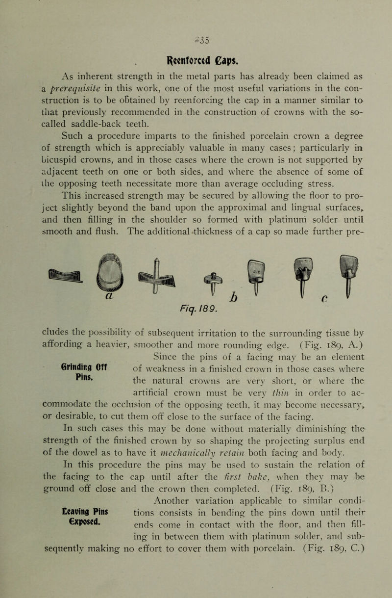 R«enfor«a Caps. As inherent strength in the metal parts has already been claimed as a prerequisite in this work, one of the most useful variations in the con- struction is to be obtained by reenforcing the cap in a manner similar to that previously recommended in the construction of crowns with the so- called saddle-back teeth. Such a procedure imparts to the finished porcelain crown a degree of strength which is appreciably valuable in many cases; particularly in bicuspid crowns, and in those cases where the crown is not supported by adjacent teeth on one or both sides, and where the absence of some of the opposing teeth necessitate more than average occluding stress. This increased strength may be secured by allowing the floor to pro- ject slightly beyond the band upon the approximal and lingual surfaces* and then filling in the shoulder so formed with platinum solder until smooth and flush. The additional .thickness of a cap so made further pre- Fiij. 189. eludes the possibility of subsequent irritation to the surrounding tissue by affording a heavier, smoother and more rounding edge. (Fig. 189, A.) Since the pins of a facing may be an element Grinding Off of weakness in a finished crown in those cases where the natural crowns are very short, or where the artificial crown must be very thin in order to ac- commodate the occlusion of the opposing teeth, it may become necessary, or desirable, to cut them off close to the surface of the facing. In such cases this may be done without materially diminishing the strength of the finished crown by so shaping the projecting surplus end of the dowel as to have it mechanically retain both facing and body. In this procedure the pins may be used to sustain the relation of the facing to the cap until after the first bake, when they may be ground off close and the crown then completed. (Fig. 189, B.) Another variation applicable to similar condi- Ceavittg Pins tions consists in bending the pins down until their €xpo$td. ends come in contact with the floor, and then fill- ing in between them with platinum solder, and sub- sequently making no effort to cover them with porcelain. (Fig. 189, C.)