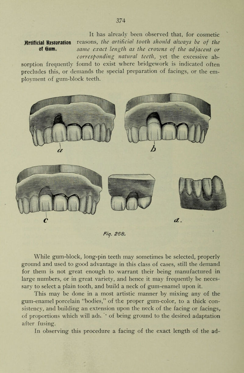 It has already been observed that, for cosmetic Artificial Restoration reasons, the artificial tooth should always he of the Of Gum, same exact length as the crowns of the adjacent or corresponding natural teeth, yet the excessive ab- sorption frequently found to exist where bridgework is indicated often precludes this, or demands the special preparation of facings, or the em- ployment of gum-block teeth. C d. Ficj. 268. While gum-block, long-pin teeth may sometimes be selected, properly ground and used to good advantage in this class of cases, still the demand for them is not great enough to warrant their being manufactured in large numbers, or in great variety, and hence it may frequently be neces- sary to select a plain tooth, and build a neck of gum-enamel upon it. This may be done in a most artistic manner by mixing any of the gum-enamel porcelain “bodies,” of the proper gum-color, to a thick con- sistency, and building an extension upon the neck of the facing or facings, of proportions which will adn L of being ground to the desired adaptation after fusing. In observing this procedure a facing of the exact length of the ad-