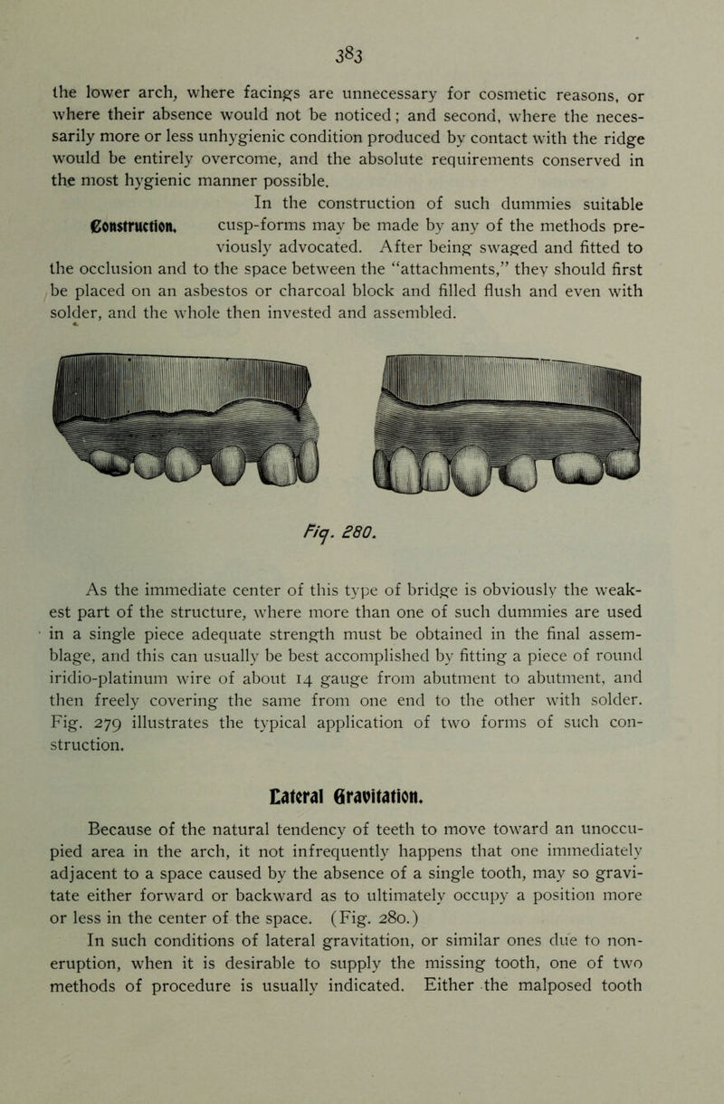 3^3 the lower arch, where facings are unnecessary for cosmetic reasons, or where their absence would not be noticed; and second, where the neces- sarily more or less unhygienic condition produced by contact with the ridge would be entirely overcome, and the absolute requirements conserved in the most hygienic manner possible. In the construction of such dummies suitable Construction, cusp-forms may be made by any of the methods pre- viously advocated. After being swaged and fitted to the occlusion and to the space between the “attachments,” they should first be placed on an asbestos or charcoal block and filled flush and even with solder, and the whole then invested and assembled. <L Ficj. 280. As the immediate center of this type of bridge is obviously the weak- est part of the structure, where more than one of such dummies are used in a single piece adequate strength must be obtained in the final assem- blage, and this can usually be best accomplished by fitting a piece of round iridio-platinum wire of about 14 gauge from abutment to abutment, and then freely covering the same from one end to the other with solder. Fig. 279 illustrates the typical application of two forms of such con- struction. Lateral Gravitation, Because of the natural tendency of teeth to move toward an unoccu- pied area in the arch, it not infrequently happens that one immediately adjacent to a space caused by the absence of a single tooth, may so gravi- tate either forward or backward as to ultimately occupy a position more or less in the center of the space. (Fig. 280.) In such conditions of lateral gravitation, or similar ones due to non- eruption, when it is desirable to supply the missing tooth, one of two methods of procedure is usually indicated. Either the malposed tooth