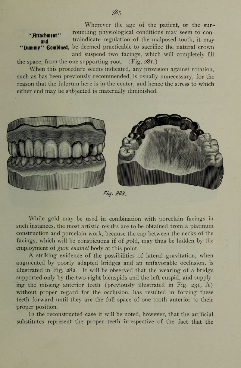 38s Wherever the age of the patient, or the sur~ **Attachment” rounding physiological conditions may seem to con- an(j traindicate regulation of the malposed tooth, it may ”Dummy” Combined, be deemed practicable to sacrifice the natural crown and suspend two facings, which will completely fill the space, from the one supporting root. (Fig. 281.) When this procedure seems indicated, any provision against rotation, such as has been previously recommended, is usually unnecessary, for the reason that the fulcrum here is in the center, and hence the stress to which either end may be subjected is materially diminished. Fiq. 283. While gold may be used in combination with porcelain facings in such instances, the most artistic results are to be obtained from a platinum construction and porcelain work, because the cap between the necks of the facings, which will be conspicuous if of gold, may thus be hidden by the employment of gum enamel body at this point. A striking evidence of the possibilities of lateral gravitation, when augmented by poorly adapted bridges and an unfavorable occlusion, is illustrated in Fig. 282. It will be observed that the wearing of a bridge supported only by the two right bicuspids and the left cuspid, and supply- ing the missing anterior teeth (previously illustrated in Fig. 231, A) without proper regard for the occlusion, has resulted in forcing these teeth forward until they are the full space of one tooth anterior to their proper position. In the reconstructed case it will be noted, however, that the artificial substitutes represent the proper teeth irrespective of the fact that the