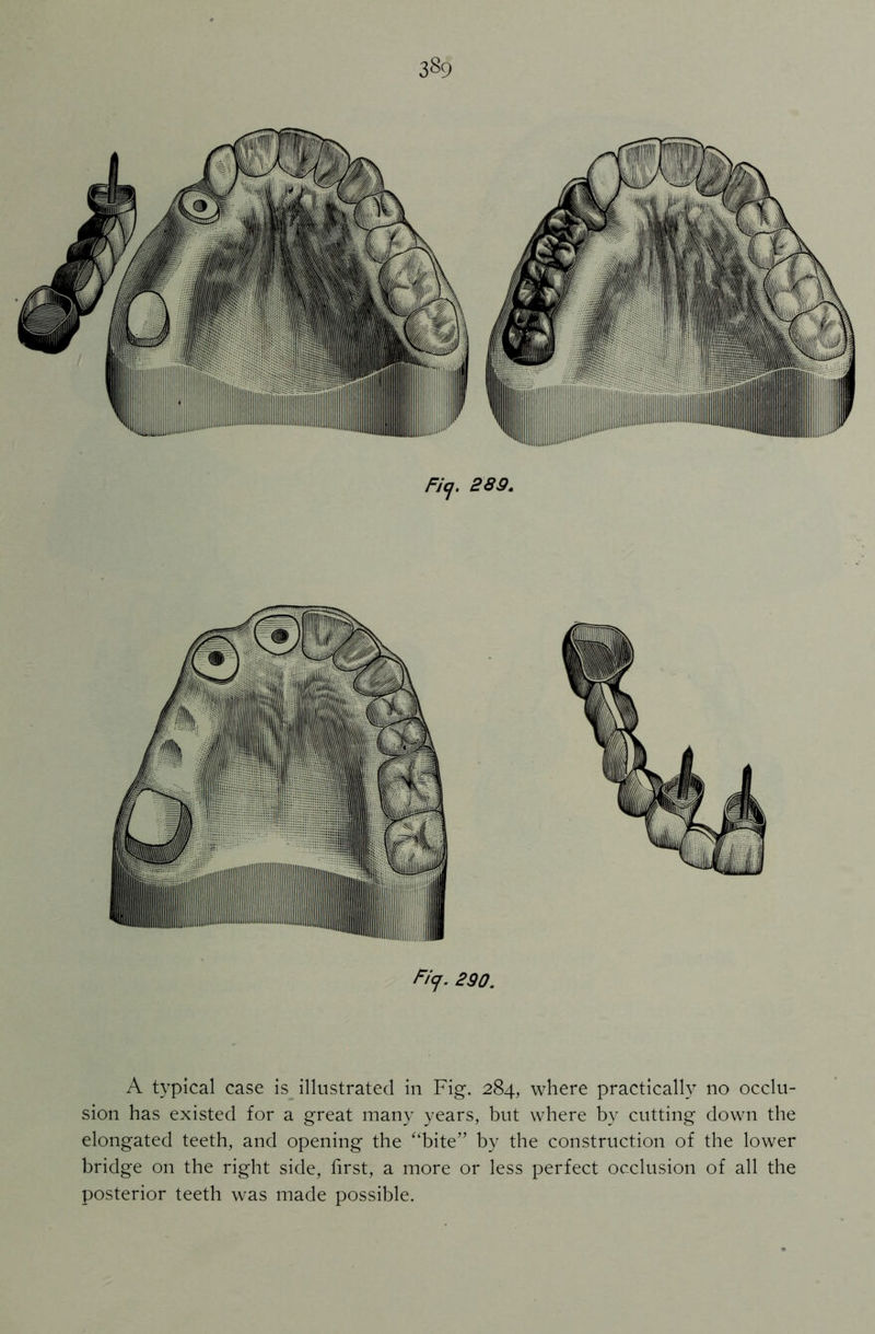 3§9 Ficj. 889. Ficj. 290. A typical case is illustrated in Fig. 284, where practically no occlu- sion has existed for a great many years, but where by cutting down the elongated teeth, and opening the “bite” by the construction of the lower bridge on the right side, first, a more or less perfect occlusion of all the posterior teeth was made possible.