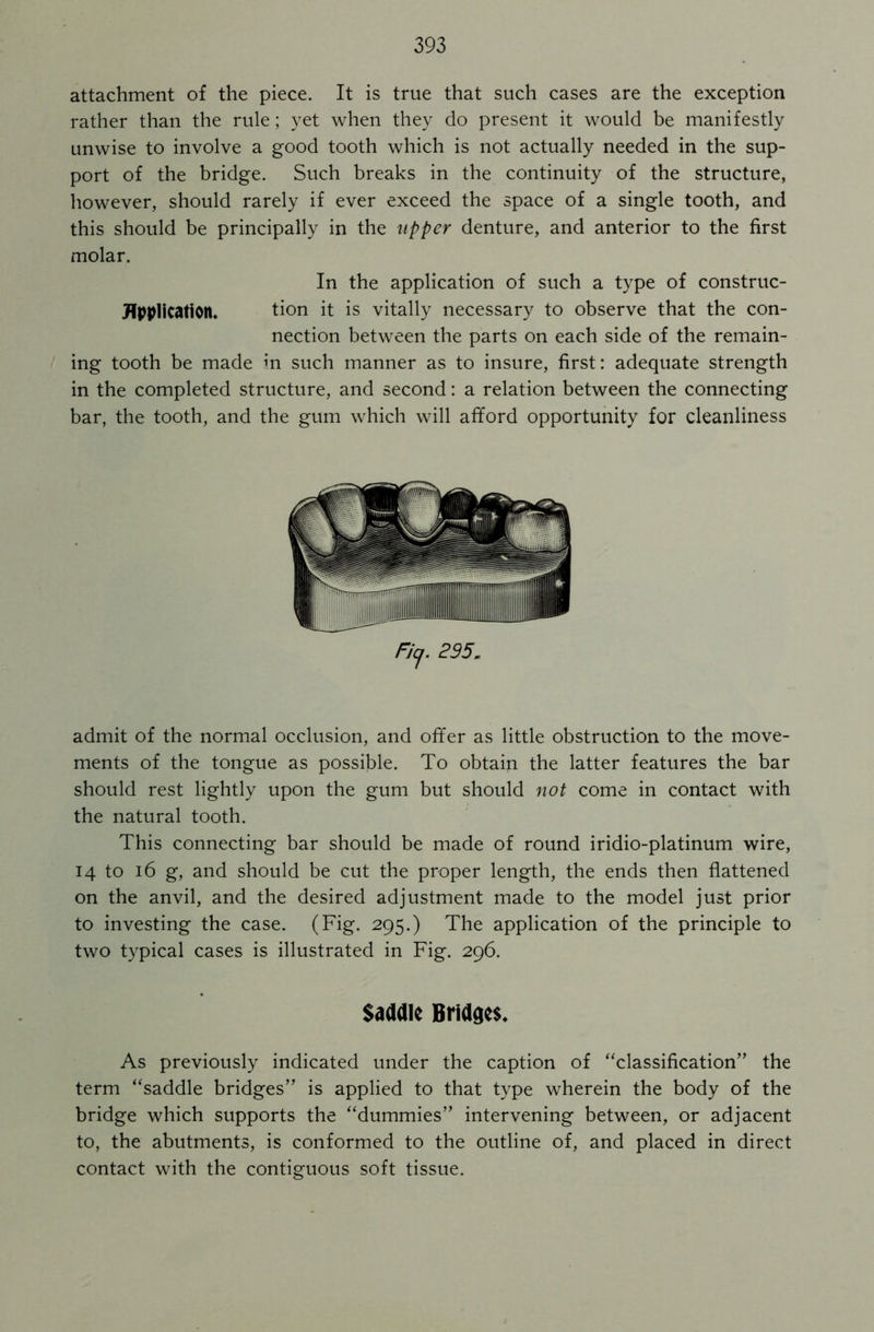 attachment of the piece. It is true that such cases are the exception rather than the rule; yet when they do present it would be manifestly unwise to involve a good tooth which is not actually needed in the sup- port of the bridge. Such breaks in the continuity of the structure, however, should rarely if ever exceed the space of a single tooth, and this should be principally in the upper denture, and anterior to the first molar. In the application of such a type of construc- JTpplication. tion it is vitally necessary to observe that the con- nection between the parts on each side of the remain- ing tooth be made in such manner as to insure, first: adequate strength in the completed structure, and second: a relation between the connecting bar, the tooth, and the gum which will afford opportunity for cleanliness FJcj. 295. admit of the normal occlusion, and offer as little obstruction to the move- ments of the tongue as possible. To obtain the latter features the bar should rest lightly upon the gum but should not come in contact with the natural tooth. This connecting bar should be made of round iridio-platinum wire, 14 to 16 g, and should be cut the proper length, the ends then flattened on the anvil, and the desired adjustment made to the model just prior to investing the case. (Fig. 295.) The application of the principle to two typical cases is illustrated in Fig. 296. Saddle Bridges* As previously indicated under the caption of “classification” the term “saddle bridges” is applied to that type wherein the body of the bridge which supports the “dummies” intervening between, or adjacent to, the abutments, is conformed to the outline of, and placed in direct contact with the contiguous soft tissue.