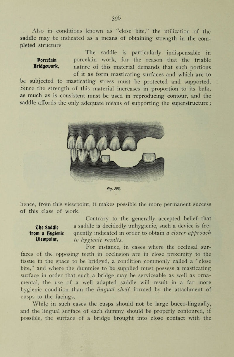 30 Also in conditions known as “close bite,” the utilization of the saddle may be indicated as a means of obtaining strength in the com- pleted structure. The saddle is particularly indispensable in Porcelain porcelain work, for the reason that the friable Bridgework, nature of this material demands that such portions of it as form masticating surfaces and which are to be subjected to masticating stress must be protected and supported. Since the strength of this material increases in proportion to its bulk, as much as is consistent must be used in reproducing contour, and the saddle affords the only adequate means of supporting the superstructure; Ficj. 298. hence, from this viewpoint, it makes possible the more permanent success of this class of work. Contrary to the generally accepted belief that tbc Saddle a saddle is decidedly unhygienic, such a device is fre- from a hygienic quently indicated in order to obtain a closer approach Uiewpoint, to hygienic results. For instance, in cases where the occlusal sur- faces of the opposing teeth in occlusion are in close proximity to the tissue in the space to be bridged, a condition commonly called a “close bite,” and where the dummies to be supplied must possess a masticating surface in order that such a bridge may be serviceable as well as orna- mental, the use of a well adapted saddle will result in a far more hygienic condition than the lingual shelf formed by the attachment of cusps to the facings. While in such cases the cusps should not be large bucco-lingually, and the lingual surface of each dummy should be properly contoured, if possible, the surface of a bridge brought into close contact with the