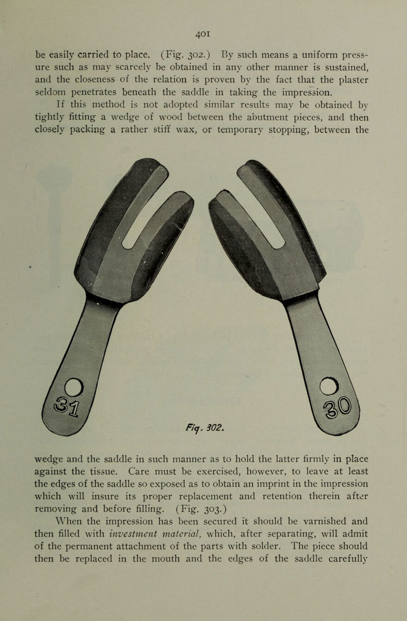 be easily carried to place. (Fig. 302.) By such means a uniform press- ure such as may scarcely be obtained in any other manner is sustained, and the closeness of the relation is proven by the fact that the plaster seldom penetrates beneath the saddle in taking the impression. If this method is not adopted similar results may be obtained by tightly fitting a wedge of wood between the abutment pieces, and then closely packing a rather stiff wax, or temporary stopping, between the wedge and the saddle in such manner as to hold the latter firmly in place against the tissue. Care must be exercised, however, to leave at least the edges of the saddle so exposed as to obtain an imprint in the impression which will insure its proper replacement and retention therein after removing and before filling. (Fig. 303.) When the impression has been secured it should be varnished and then filled with investment material, which, after separating, will admit of the permanent attachment of the parts with solder. The piece should then be replaced in the mouth and the edges of the saddle carefully