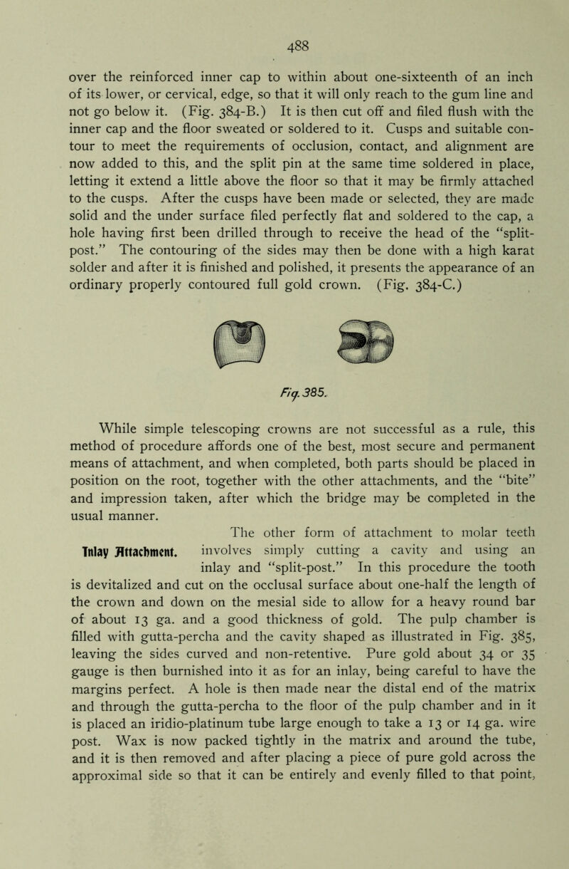 over the reinforced inner cap to within about one-sixteenth of an inch of its lower, or cervical, edge, so that it will only reach to the gum line and not go below it. (Fig. 384-B.) It is then cut off and filed flush with the inner cap and the floor sweated or soldered to it. Cusps and suitable con- tour to meet the requirements of occlusion, contact, and alignment are now added to this, and the split pin at the same time soldered in place, letting it extend a little above the floor so that it may be firmly attached to the cusps. After the cusps have been made or selected, they are made solid and the under surface filed perfectly flat and soldered to the cap, a hole having first been drilled through to receive the head of the “split- post.” The contouring of the sides may then be done with a high karat solder and after it is finished and polished, it presents the appearance of an ordinary properly contoured full gold crown. (Fig. 384-C.) Fiy. 385. While simple telescoping crowns are not successful as a rule, this method of procedure affords one of the best, most secure and permanent means of attachment, and when completed, both parts should be placed in position on the root, together with the other attachments, and the “bite” and impression taken, after which the bridge may be completed in the usual manner. The other form of attachment to molar teeth Tttlay Attachment. involves simply cutting a cavity and using an inlay and “split-post.” In this procedure the tooth is devitalized and cut on the occlusal surface about one-half the length of the crown and down on the mesial side to allow for a heavy round bar of about 13 ga. and a good thickness of gold. The pulp chamber is filled with gutta-percha and the cavity shaped as illustrated in Fig. 385, leaving the sides curved and non-retentive. Pure gold about 34 or 35 gauge is then burnished into it as for an inlay, being careful to have the margins perfect. A hole is then made near the distal end of the matrix and through the gutta-percha to the floor of the pulp chamber and in it is placed an iridio-platinum tube large enough to take a 13 or 14 ga. wire post. Wax is now packed tightly in the matrix and around the tube, and it is then removed and after placing a piece of pure gold across the approximal side so that it can be entirely and evenly filled to that point,