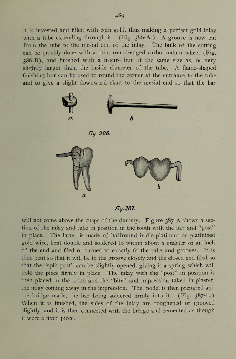 it is invested and filled with coin gold, thus making a perfect gold inlay with a tube extending through it. (Fig. 386-A.) A groove is now cut from the tube to the mesial end of the inlay. The bulk of the cutting- can be quickly done with a thin, round-edged carborundum wheel (Fig. 386-B), and finished with a fissure bur of the same size as, or very slightly larger than, the inside diameter of the tube. A flame-shaped finishing bur can be used to round the corner at the entrance to the tube and to give a slight downward slant to the mesial end so that the bar a h Fi(j. 386L Fig. 387. will not come above the cusps of the dummy. Figure 387-A shows a sec- tion of the inlay and tube in position in the tooth with the bar and “post” in place. The latter is made of halfround iridio-platinum or platinized gold wire, bent double and soldered to within about a quarter of an inch of the end and filed or turned to exactly fit the tube and grooves. It is then bent so that it will lie in the groove closely and the closed end filed so that the “split-post” can be slightly opened, giving it a spring which will hold the piece firmly in place. The inlay with the “post” in position is then placed in the tooth and the “bite” and impression taken in plaster, the inlay coming away in the impression. The model is then prepared and the bridge made, the bar being soldered firmly into it. (Fig. 387-B.) When it is finished, the sides of the inlay are roughened or grooved slightly, and it is then connected with the bridge and cemented as though it were a fixed piece.