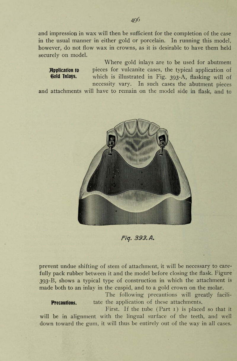 and impression in wax will then be sufficient for the completion of the case in the usual manner in either gold or porcelain. In running this model, however, do not flow wax in crowns, as it is desirable to have them held securely on model. Where gold inlays are to be used for abutment Application to pieces for vulcanite cases, the typical application of Gold Inlays, which is illustrated in Fig. 393-A, flasking will of necessity vary. In such cases the abutment pieces and attachments will have to remain on the model side in flask, and to Ficj. 393. A, prevent undue shifting of stem of attachment, it will be necessary to care- fully pack rubber between it and the model before closing the flask. Figure 393-B, shows a typical type of construction in which the attachment is made both to an inlay in the cuspid, and to a gold crown on the molar. The following precautions will greatly facili- Prccautions. tate the application of these attachments. First. If the tube (Part 1) is placed so that it will be in alignment with the lingual surface of the teeth, and well down toward the gum, it will thus be entirely out of the way in all cases.