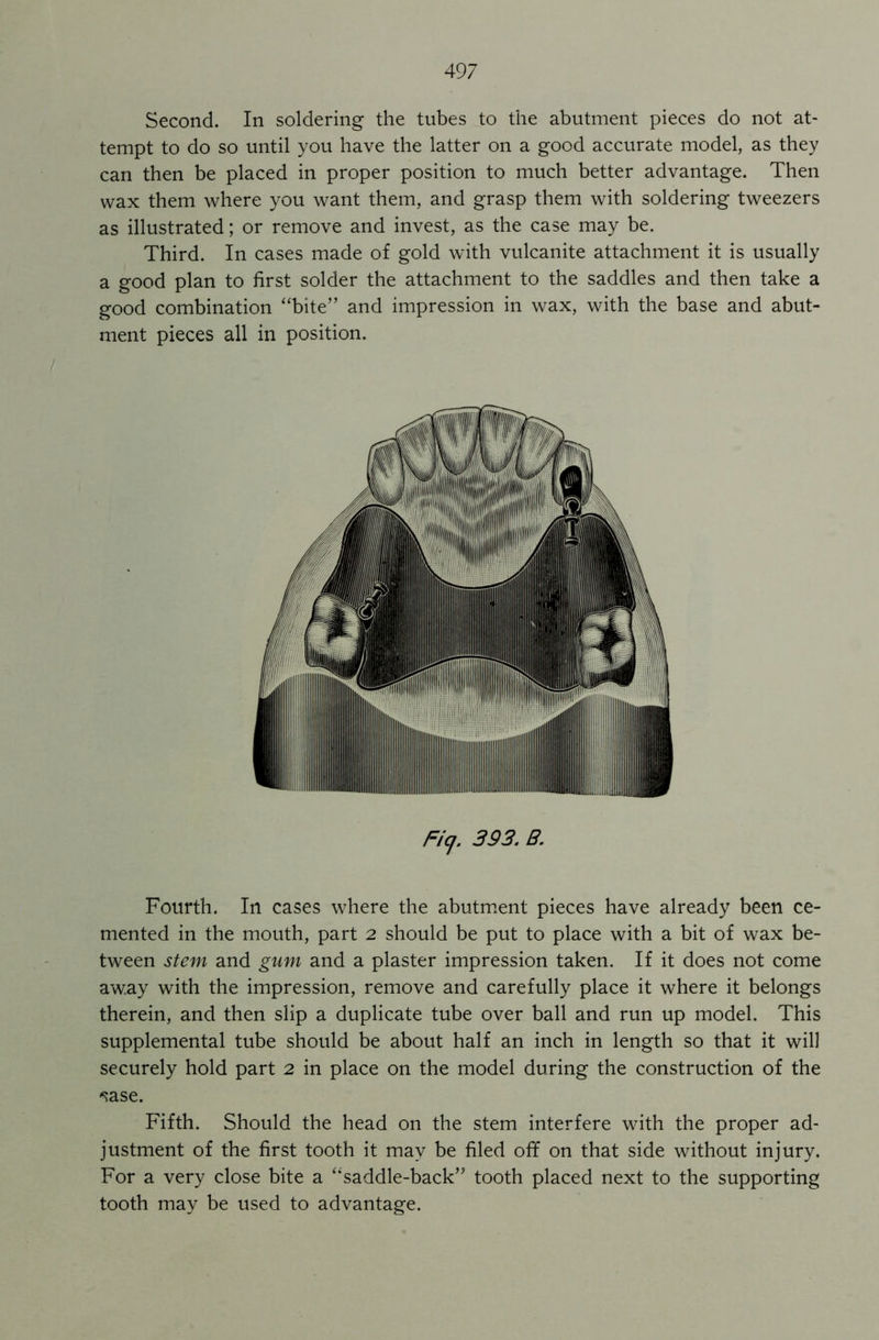 Second. In soldering the tubes to the abutment pieces do not at- tempt to do so until you have the latter on a good accurate model, as they can then be placed in proper position to much better advantage. Then wax them where you want them, and grasp them with soldering tweezers as illustrated; or remove and invest, as the case may be. Third. In cases made of gold with vulcanite attachment it is usually a good plan to first solder the attachment to the saddles and then take a good combination “bite” and impression in wax, with the base and abut- ment pieces all in position. Ficj. 393. B. Fourth. In cases where the abutment pieces have already been ce- mented in the mouth, part 2 should be put to place with a bit of wax be- tween stem and gum and a plaster impression taken. If it does not come away with the impression, remove and carefully place it where it belongs therein, and then slip a duplicate tube over ball and run up model. This supplemental tube should be about half an inch in length so that it will securely hold part 2 in place on the model during the construction of the 'sase. Fifth. Should the head on the stem interfere with the proper ad- justment of the first tooth it may be filed off on that side without injury. For a very close bite a “saddle-back” tooth placed next to the supporting tooth may be used to advantage.