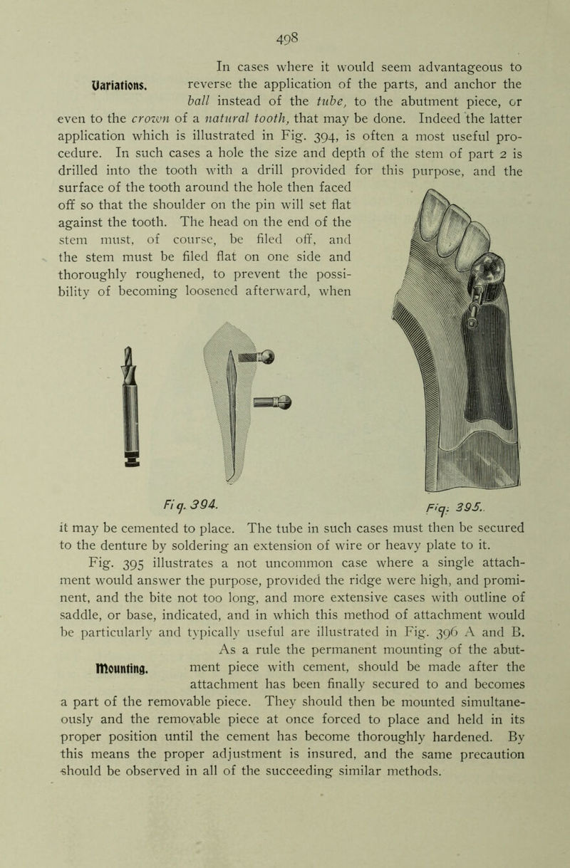 In cases where it would seem advantageous to Uariations. reverse the application of the parts, and anchor the ball instead of the tube, to the abutment piece, or even to the crozvn of a natural tooth, that may be done. Indeed the latter application which is illustrated in Fig. 394, is often a most useful pro- cedure. In such cases a hole the size and depth of the stem of part 2 is drilled into the tooth with a drill provided for this purpose, and the surface of the tooth around the hole then faced off so that the shoulder on the pin will set flat against the tooth. The head on the end of the stem must, of course, be filed off, and the stem must be filed flat on one side and thoroughly roughened, to prevent the possi- bility of becoming loosened afterward, when Fi cj. 394. f=ICj, 3QS.. it may be cemented to place. The tube in such cases must then be secured to the denture by soldering an extension of wire or heavy plate to it. Fig. 395 illustrates a not uncommon case where a single attach- ment would answer the purpose, provided the ridge were high, and promi- nent, and the bite not too long, and more extensive cases with outline of saddle, or base, indicated, and in which this method of attachment would be particularly and typically useful are illustrated in Fig. 396 A and B. As a rule the permanent mounting of the abut- Mounting. ment piece with cement, should be made after the attachment has been finally secured to and becomes a part of the removable piece. They should then be mounted simultane- ously and the removable piece at once forced to place and held in its proper position until the cement has become thoroughly hardened. By this means the proper adjustment is insured, and the same precaution ■should be observed in all of the succeeding similar methods.