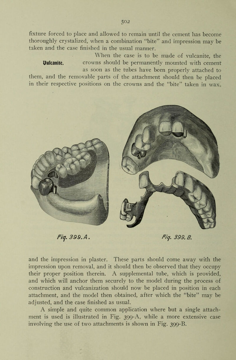 fixture forced to place and allowed to remain until the cement has become thoroughly crystalized, when a combination “bite” and impression may be taken and the case finished in the usual manner. When the case is to be made of vulcanite, the Uwlcanite, crowns should be permanently mounted with cement as soon as the tubes have been properly attached to them, and the removable parts of the attachment should then be placed in their respective positions on the crowns and the “bite” taken in wax, Ficj. 399. A. Ficj. 399. B. and the impression in plaster. These parts should come away with the impression upon removal, and it should then be observed that they occupy their proper position therein. A supplemental tube, which is provided, and which will anchor them securely to the model during the process of construction and vulcanization should now be placed in position in each attachment, and the model then obtained, after which the “bite” may be adjusted, and the case finished as usual. A simple and quite common application where but a single attach- ment is used is illustrated in Fig. 399-A, while a more extensive case involving the use of two attachments is shown in Fig. 399-B.