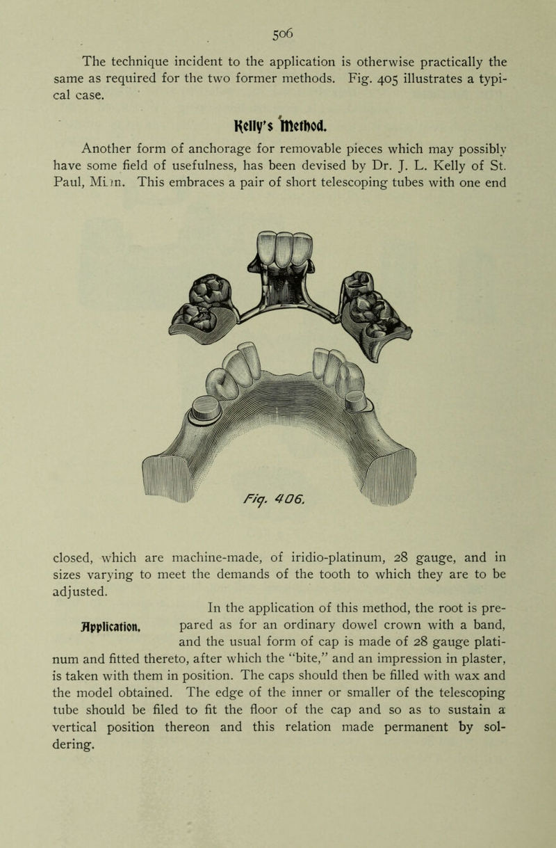 5°6 The technique incident to the application is otherwise practically the same as required for the two former methods. Fig. 405 illustrates a typi- cal case. Kelly's method. Another form of anchorage for removable pieces which may possibly have some field of usefulness, has been devised by Dr. J. L. Kelly of St. Paul, MLin. This embraces a pair of short telescoping tubes with one end closed, which are machine-made, of iridio-platinum, 28 gauge, and in sizes varying to meet the demands of the tooth to which they are to be adjusted. In the application of this method, the root is pre- flpplication. pared as for an ordinary dowel crown with a band, and the usual form of cap is made of 28 gauge plati- num and fitted thereto, after which the “bite,” and an impression in plaster, is taken with them in position. The caps should then be filled with wax and the model obtained. The edge of the inner or smaller of the telescoping tube should be filed to fit the floor of the cap and so as to sustain a vertical position thereon and this relation made permanent by sol- dering.