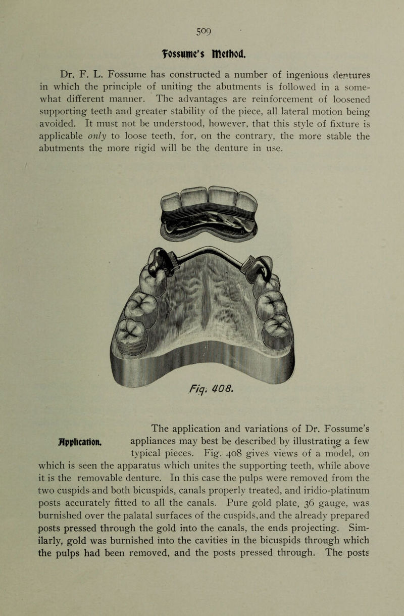 fossume's method. Dr. F. L. Fossume has constructed a number of ingenious dentures in which the principle of uniting the abutments is followed in a some- what different manner. The advantages are reinforcement of loosened supporting teeth and greater stability of the piece, all lateral motion being avoided. It must not be understood, however, that this style of fixture is applicable only to loose teeth, for, on the contrary, the more stable the abutments the more rigid will be the denture in use. The application and variations of Dr. Fossume’s Application. appliances may best be described by illustrating a few typical pieces. Fig. 408 gives views of a model, on which is seen the apparatus which unites the supporting teeth, while above it is the removable denture. In this case the pulps were removed from the two cuspids and both bicuspids, canals properly treated, and iridio-platinum posts accurately fitted to all the canals. Pure gold plate, 36 gauge, was burnished over the palatal surfaces of the cuspids, and the already prepared posts pressed through the gold into the canals, the ends projecting. Sim- ilarly, gold was burnished into the cavities in the bicuspids through which the pulps had been removed, and the posts pressed through. The posts