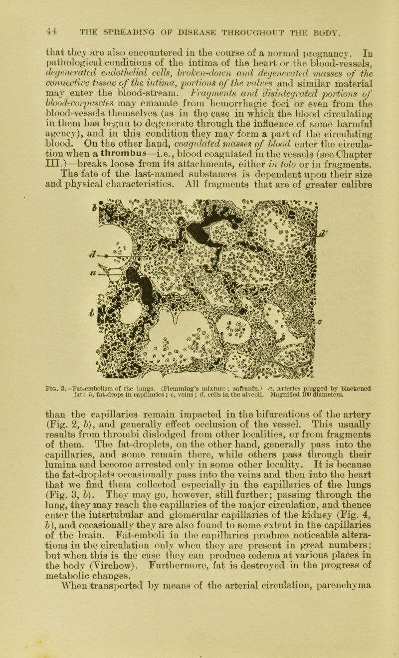tbat tliey are also encountered in tlie course of a normal pregnancy. In patliological conditions of tlie intima of tlie heart or the blood-vessels, degenerated endothelial cells, drohen-down and degenerated masses of the connective tissue of the intima, portions of the valves and similar material may enter tlie blood-stream. Fragments and disintegrated portions of hlood-corpuscles may emanate from liemorrliagic foci or even from tlie blood-vessels tliemselves (as in tlie case in wliicli tlie blood circulating in tliem lias begun to degenerate through tlie influence of some liarmful agency), and in tliis condition tliey may form a part of tlie circulating blood. On tlie otber band, coagulated masses of blood enter tlie circula- tion wlien a thrombus—i.e., blood coagulated in tlie vessels (see Cbapter III.)—breaks loose from its attacbments, eitlier in toto or in fragments. Tbe fate of the last-named substances is dependent upon tbeir size and pbysical characteristics. All fragments tbat are of greater calibre FlG. 3.—Fat-embolism of the lungs. (Flemming’s mixturo; safranin.) n, Arteries plugged by blackened tat; />, fat-drops in capillaries; c, veins ; d, eells in the alveoli. Magnifled 100 diameters. tlian tbe capillaries remain impacted in tbe bifurcations of tbe artery (Fig. 2, b), and generally effect occlusion of tbe vessel. Tliis usually results from tlirombi clislodged from otber localities, or from fragments of tliem. Tbe fat-droplets, on tbe otber band, generally pass into tbe capillaries, and some remain tliere, wliile otbers pass through tbeir lumina and become arrested only in some otber locality. It is because tbe fat-droplets occasionally pass into tbe veins and tben into tbe heart tbat we find tliem collected especially in tbe capillaries of tbe lungs (Fig. 3, b). Tliey may go, bowever, still furtber; passing through tbe lung, tliey may reacli tbe capillaries of tbe major circulation, and tbence enter tbe intertubular and glomerular capillaries of tbe kidney (Fig. 4, b), and occasionally tliey are also found to some extent in tbe capillaries of tbe brain. Fat-emboli in tbe capillaries produce noticeable altera- tions in tbe circulation only when tliey are present in great numbers; but wlien tliis is tbe case tliey can produce cedema at various places in tbe bodv (Yircliow). Furtbermore, fat is destroyed in tbe progress of metabolic cbanges. Wlien transported by means of tbe arterial circulation, parencliyma