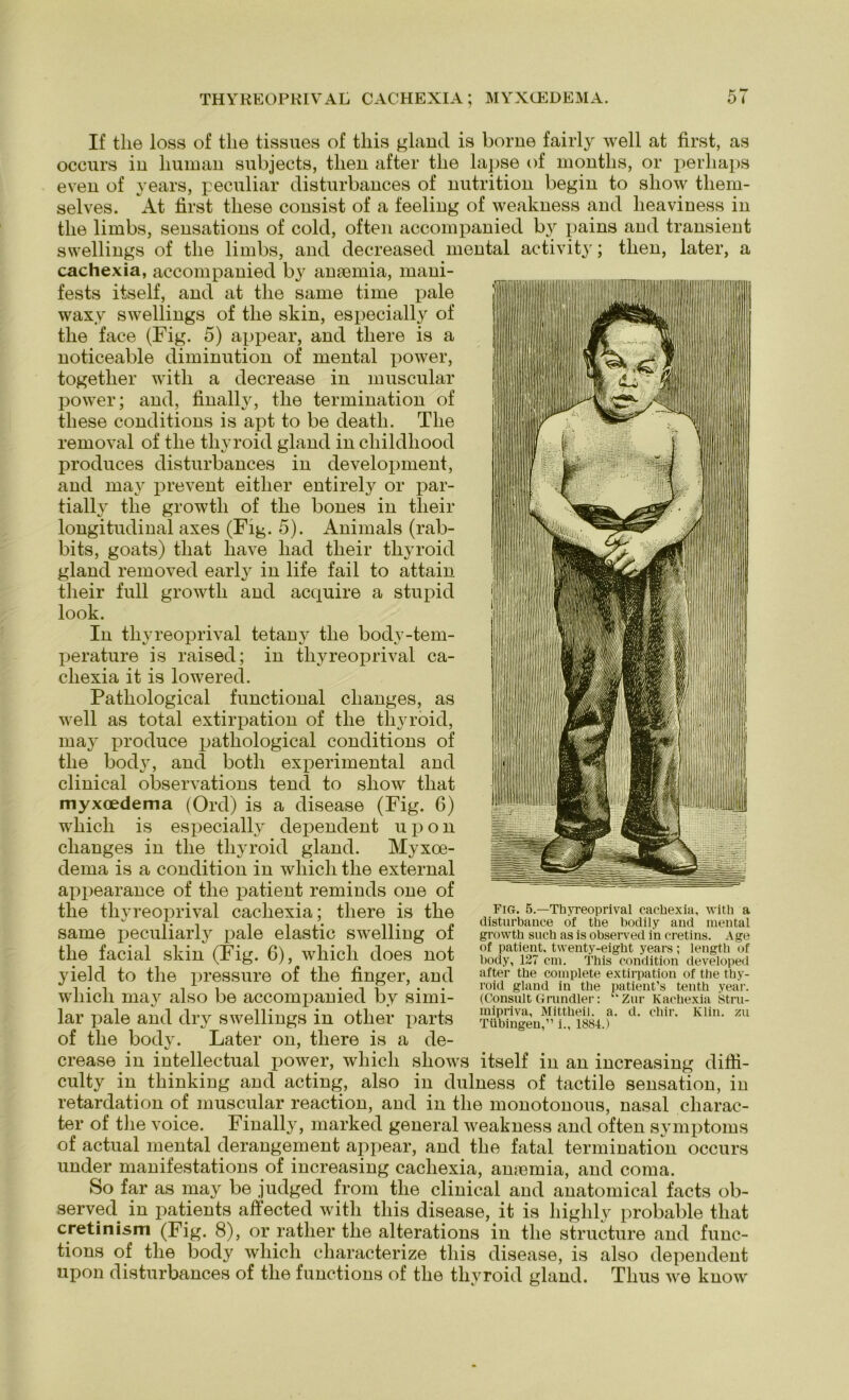 If tlie loss of tlie tissues of tliis gland is borne fairly well at first, as occurs in human subjects, tlien after tlie lapse of montlis, or perhaps even of years, peculiar disturbances of nutrition begin to show tliem- selves. At first tliese consist of a feeling of weakness and lieaviness in tlie limbs, sensations of cold, often accompanied by pains and transient swellings of tlie limbs, and decreased mental activity; tlien, later, a cachexia, accompanied by ansemia, mani- fests itself, and at tlie same time pale waxy swellings of tlie skin, especially of tlie face (Fig. 5) appear, and tliere is a noticeable diminution of mental power, togetlier with a decrease in muscular power; and, finally, tlie termination of tliese conditions is apt to be death. The removal of tlie tliyroid gland in cliildliood produces disturbances in development, and may prevent eitlier entirely or par- tially tlie growtli of tlie bones in tlieir longitudinal axes (Fig. 5). Animais (rab- bits, goats) tliat liave had tlieir tliyroid gland removed early in life fail to attain tlieir full growtli and acquire a stupid look. In tliyreoprival tetany tlie body-tem- perature is raised; in tliyreoprival ca- chexia it is lowered. Pathological functional changes, as well as total extirpation of tlie tliyroid, may produce pathological conditions of tlie body, and botli experimental and clinical observations tencl to show tliat myxoedema (Ord) is a disease (Fig. 6) whicli is especially dependent upon changes in tlie tliyroid gland. Myxoe- dema is a condition in wliicli the external appearance of the patient reminds one of the tliyreoprival cachexia; tliere is the same peculiarly pale elastic swelling of the facial skin (Fig. 6), whicli does not yield to the pressure of the finger, and wliicli may also be accompanied by simi- lar pale and dry swellings in otlier parts of the body. Later on, tliere is a de- crease in intellectual power, wliicli shows itself in an increasing difii- culty in thinking and acting, also in dulness of tactile Sensation, in retardation of muscular reaction, and in the monotonous, nasal charac- ter of the voice. Finally, marked general weakness and often Symptoms of actual mental derangement appear, and the fatal termination occurs under manifestations of increasing cachexia, amemia, and coma. So far as may be judged from the clinical and anatomical facts ob- served in patients affected with tliis disease, it is higlily probable tliat cretinism (Fig. 8), or rather the alterations in the structure and func- tions of the body whicli characterize tliis disease, is also dependent upon disturbances of the functions of the tliyroid gland. Tlius we know Fig. 5.—Thyreoprival cachexia, with a disturbance of the bodily and mental growth such as is observed in cretins. Age of patient, twenty-eight years; length of body, 127 cm. This condition developed after the coinplete extirpation of the thy- roid gland in the patient’s tenth year. (Consult Grundier: “ Zur Kachexia Stru- mipriva, Mittheil. a. d. cliir. Klin. zu Tübingen,” i„ 1884.)