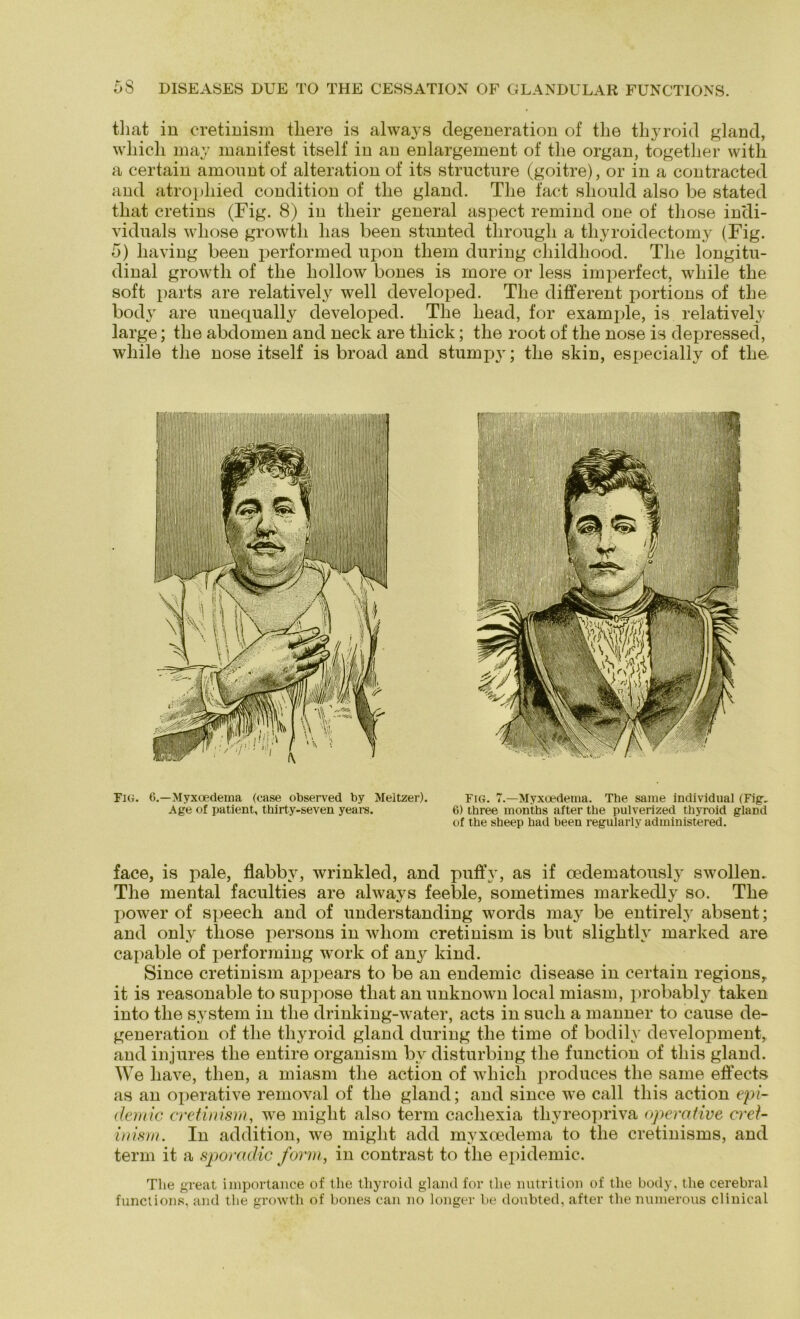 tliat in cretinism tliere is always degeneration of the thyroid gland, wliicli may manifest itself in an enlargement of the organ, together with a certain amount of alteration of its structure (goitre), or in a contracted and atropliied condition of tlie gland. The fact sliould also be stated tliat cretins (Fig. 8) in their general aspect remind one of those indi- viduals wliose growtli has been stunted through a tliyroidectomy (Fig. 5) liaving been performed upon them during childliood. The longitu- dinal growtli of the liollow bones is rnore or less imperfect, wliile the soft parts are relatively well developed. The different portions of the body are unequally developed. The liead, for example, is relatively large; the abdomen and neck are tliick; the root of the nose is depressed, wliile the nose itself is broad and stumpy*; the skin, especially of the Fig. 6.—Myxoedema (case observed by Meitzer). Age of patient, thirty-seven years. Fig. 7.—Myxoedema. Tbe same individual (Fig, 6) three months after the pulverized thyroid gland of the sheep had been regularly adininistered. face, is pale, flabbv, wrinkled, and puffy, as if oedematously swollen.. The mental faculties are always feeble, sometimes markedly so. The power of speecli and of understanding words may be entirely absent; and only those persons in whom cretinism is but slightly marked are capable of performing work of any kind. Since cretinism appears to be an endemic disease in certain regions,, it is reasonable to suppose tliat an unknown local miasm, probably taken into the System in the drinking-water, acts in such a manner to cause de- generation of the thyroid gland during the time of bodily development, and injures the entire organism by disturbing the function of tliis gland. We have, tlien, a miasm the action of which produces the same effects as an operative removal of the gland; and since we call tliis action epi- demic cretinism, we miglit also term cachexia tliyreopriva operative crei- inisrn. In addition, we miglit add myxoedema to the cretinisms, and term it a sporcidic form, in contrast to the epidemic. The great importance of the thyroid gland for tlie nutrition of tlie body, the cerebral functions, and the growtli of bones can no longer be doubted, after the numerous clinical