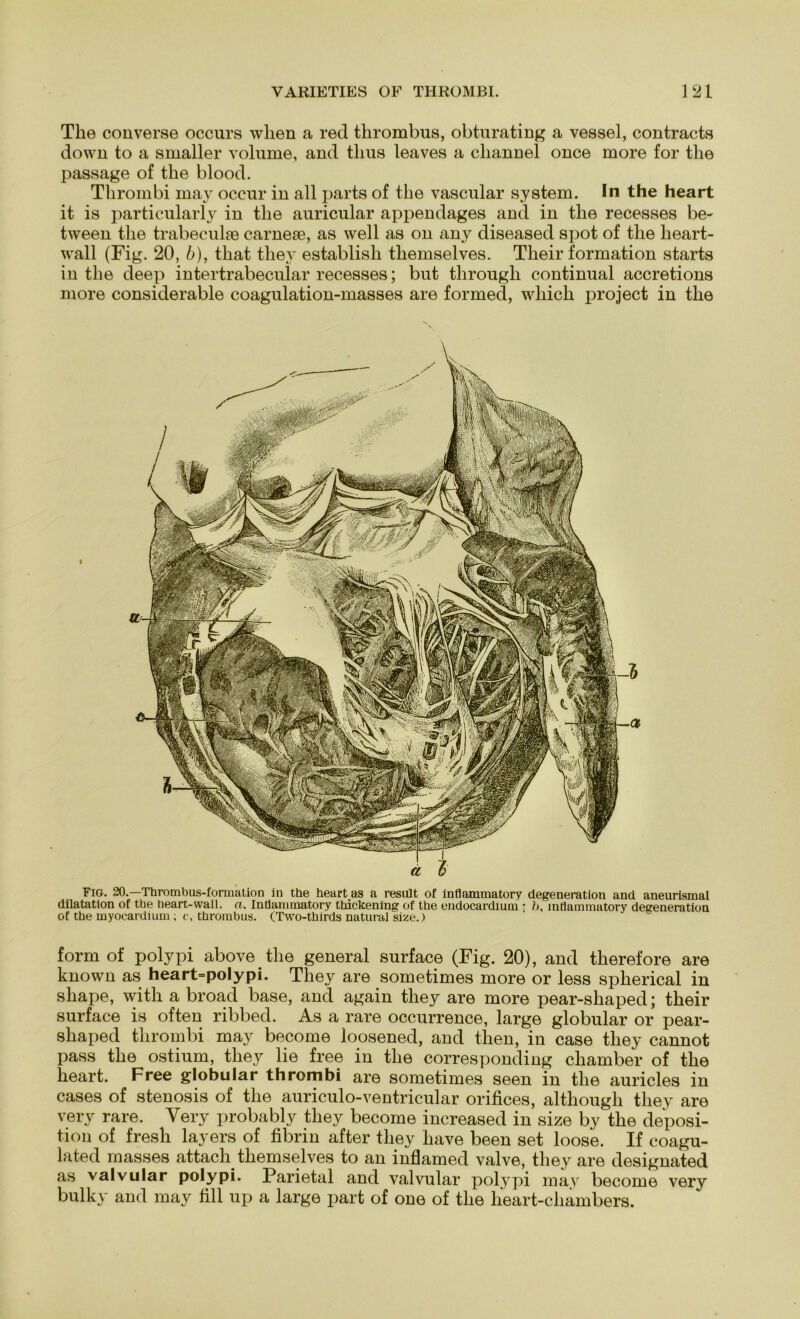 The converse occurs wlien a red thrombus, obturating a vessel, contracts down to a smaller volume, and tlius leaves a channel once more for the passage of the blood. Thrombi may occur in all parts of the vascular System. In the heart it is particularly in the auricular appendages and in the recesses be- tween the trabeculse carneae, as well as on any diseased spot of the heart- wall (Fig. 20, b), that they establish tliemselves. Their formation starts in the deep intertrabecular recesses; but througli continual accretions more considerable coagulation-masses are formed, wliich £>roject in the d Fig. 20.- Thrombus-fonnation in the heartas a resitlt of inflanimatory degeneration and aneurismal dilatation of the heart-wall. a. Inflanimatory thickening of the endocardium • h, inflammatory degeneration of the myocardium ; e, thrombus. (Two-thirds natural size.) form of polypi above the general surface (Fig. 20), and therefore are known as heart=po!ypi. They are sometimes more or less splierical in shape, witli a broad base, and again they are more pear-shaped; their surface is often ribbed. As a rare occurrence, large globular or pear- shaped thrombi may become loosened, and then, in case they cannot pass the ostium, they lie free in the corresponding chamber of the heart. Free globular thrombi are sometimes seen in the auricles in cases of stenosis of the auriculo-ventricular orifices, although they are very rare. Very probably they become increased in size by the deposi- tion of fresh layers of fibrin after they have been set loose. If coagu- lated masses attach themselves to an inflamed valve, they are designated as valvular polypi. Parietal and valvular polypi may become very bulky and may fill up a large part of one of the lieart-chambers.