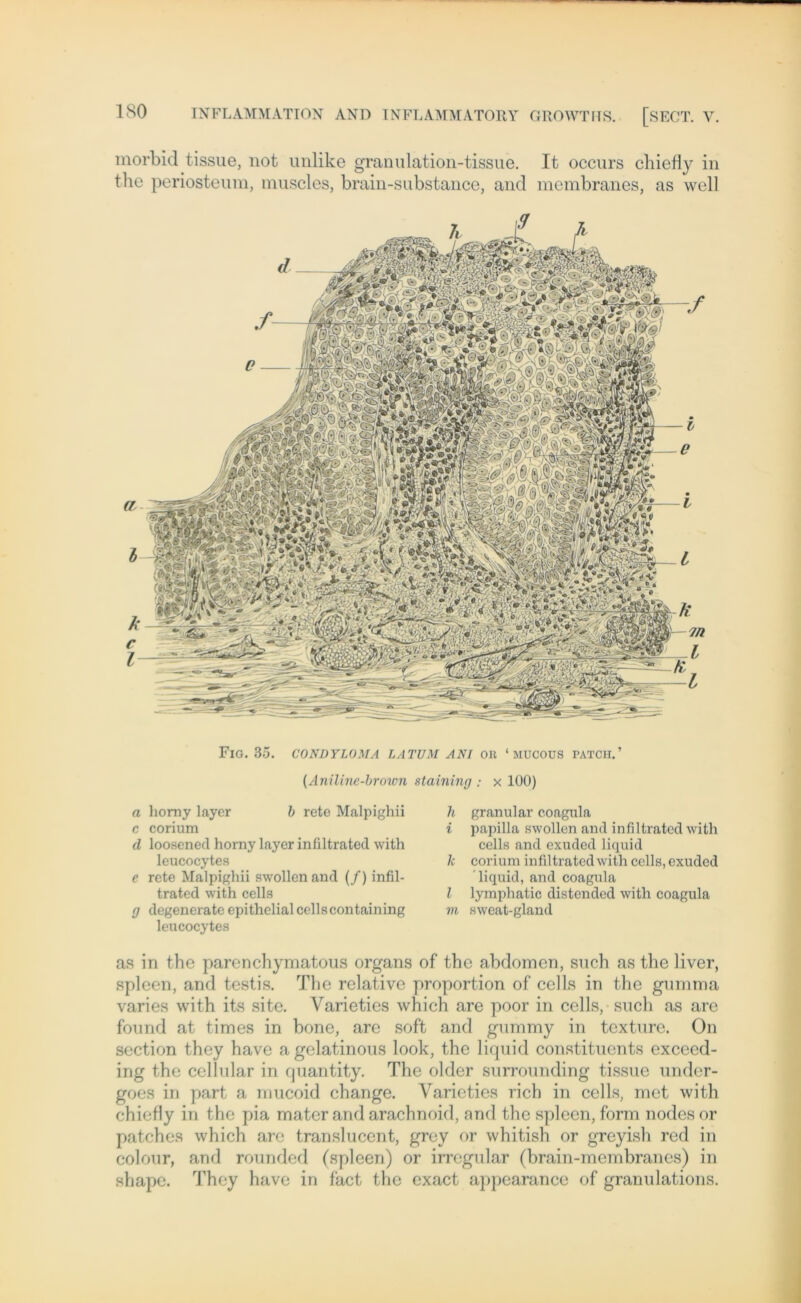 morbid tissue, not unlike granulation-tissue. It occurs cbiefly in the periostcum, muscles, brain-substance, and membranes, as well FlG. 35. CONDYLOMA LATUM ANI Olt ‘ MUCOUS PATCH.’ (Aniline-brown staining : x 100) a liorny layer b rete Malpighii c corium d loosened horny layer infiltrated with leucocytes e rete Malpighii swollen and (/) infil- trated with cells g degenerate epithelial cellscontaining leucocytes h granulär coagula i papilla swollen and infiltrated with cells and exuded liquid k corium infiltrated with cells, exuded liquid, and coagula l lymphatic distended with coagula m sweat-gland as in the parenchymatous organs of tbe abdomen, such as the liver, spieen, and testis. The relative proportion of cells in the gumma varies with its site. Varieties which are poor in cells, such as are found at tim es in hone, are soft and gummy in tcxture. On section they have a gelatinous look, the liquid constituents exceed- ing the cellular in quantity. The older surrounding tissue under- goes in part a mucoid change. Varieties rieh in cells, met with chiefiy in the pia mater and arachnoid, and the spieen, form nodesor patches which are translucent, grey or whitish or greyish red in colour, and rounded (spieen) or irregulär (brain-membranes) in shape. They have in fact the exact appearance of granulations.