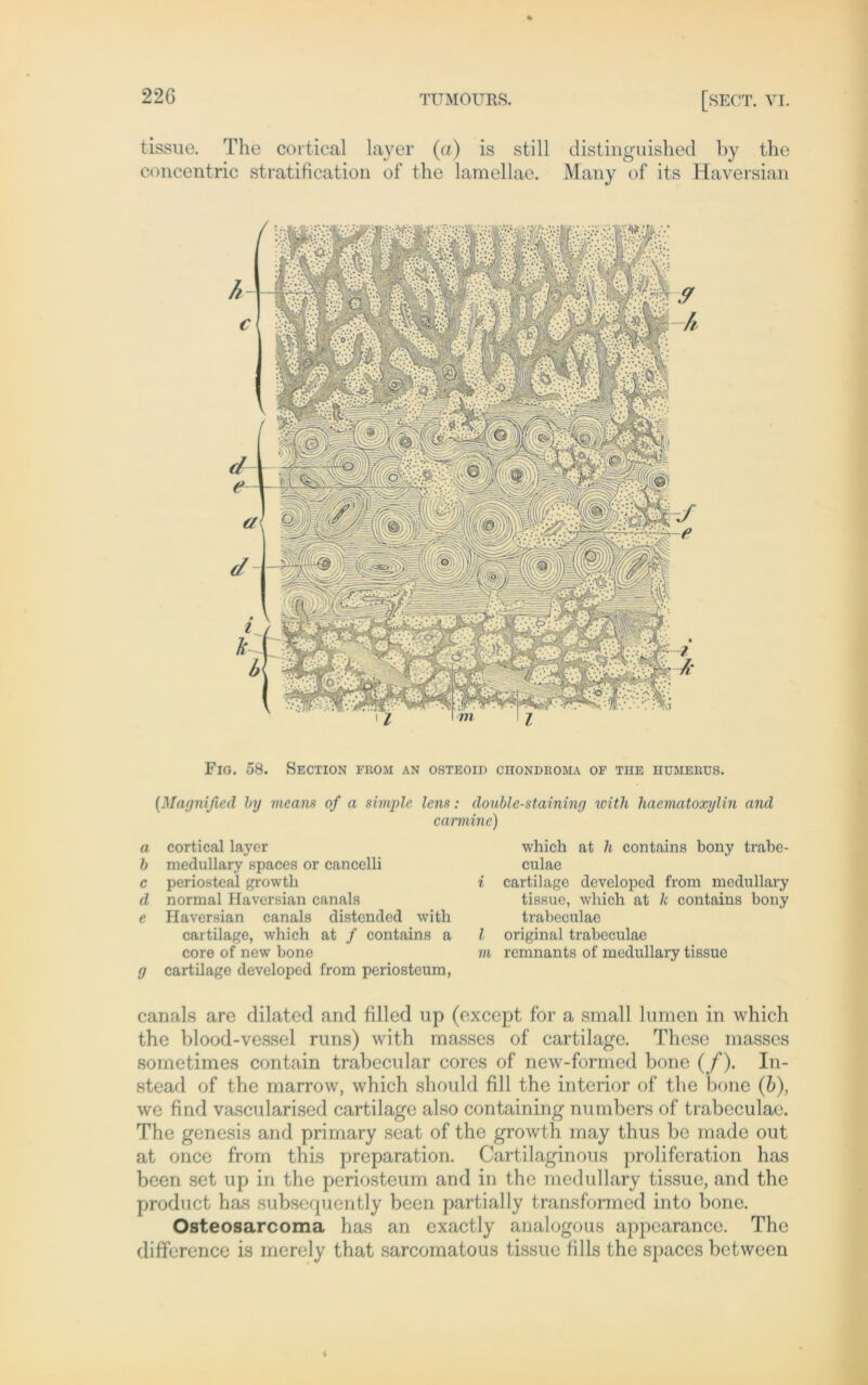 tissuc. The cortical layer (a) is still distinguished by the concentric stratification of the lamellae. Many of its Haversian Fio. 58. Section from an OSTEOID CHONDROMA OE THE HUMERUS. (Magnified by means of a simple lens: doublestaininy with haematoxylin and camiinc) a cortical layer b medullary spaces or cancelli c periosteal growtli d normal Haversian canals e Haversian canals distendcd with cartilage, which at / contains a core of new hone y cartilage developed from periosteum, which at li contains bony trabe- culae i cartilage developed from medullary tissue, which at k contains bony trabeculae l original trabeculae m remnants of medullary tissue canals are dilated and filled up (except for a small lnmen in which the blood-vessel runs) with masses of cartilage. These masses sometimes contain trabecidar cores of new-formed bone (/). In- stead of the marrow, which should fill the inferior of the bone (b), we find vascularised cartilage also containing numbers of trabeculae. The genesis and primary seat of the growth may thus be made out at once from this preparation. Cartilaginous proliferation has been set up in the periosteum and in the medullary tissuc, and the product has subsequently been partially transformed into bone. Osteosarcoma has an exactly analogous appcarance. The difference is merely that sarcomatous tissue fills the spaces betwecn