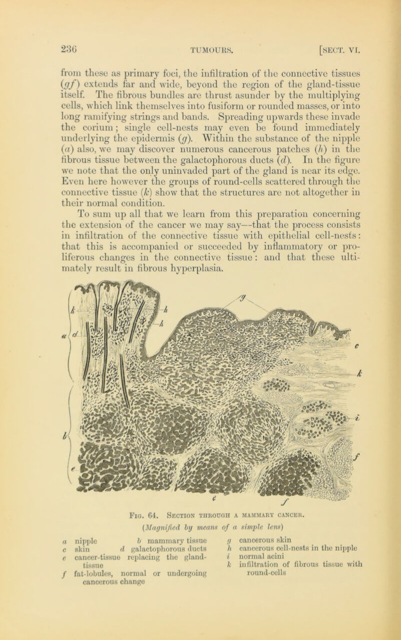 from these as primary foci, the infiltration of tlie comicctivc tissues (gf) extends far and wide, beyond tlic region of the gland-tissue itself. The fibrous bundles are thrust asunder by the multiplying cells, which link themselves into fusiform or rounded masses, or into long ramifying strings and bands. Spreading upwards these invade the corium; single cell-nests may even be found immediately underlying the epidermis (g). Within the substance of the nipple (a) also, we may discover numerous cancerous patches (//■) in the fibrous tissue between the galactophorous ducts (d). In the figure we note that the only uninvaded part of the gland is ncar its edge. Even liere however the groups of round-cells scattered through tlie connective tissue (k) show that the structures are not altogether in their normal condition. To sum up all that we learn froin this preparation concerning the extension of the cancer we may say—that the process consists in infiltration of the connective tissue with epithelial cell-nests: that this is accompanied or succeeded by infiammatory or pro- liferous changes in the connective tissue : and that these ulti- mately result in fibrous hyperplasia. Fio. 64. Section through a mammary cancer. (Magnified by meaiis of a simple lens) a nipple b mammary tissue c skin d galactophorous ducts e cancer-tissuo replacing the gland- tissue / fat-lobules, normal or undergoing cancerous change g cancerous skin h cancerous cell-nests in the nipple i normal aeini k infiltration of fibrous tissue with round-cells