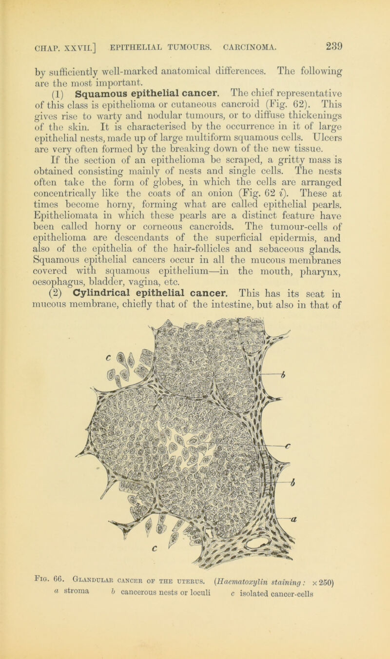 Fig. 66. Glandulae cancee oe the uteeus. (Haematoxylin staining: x 251 a stroma b cancerous nests or loculi c isolated cancer-cells by sufficiently well-marked anatomical differences. The following are the most important. (1) Squamous epithelial cancer. The chief representative of this dass is epithelioma or cutaneous cancroid (Fig. 62). This gives rise to warty and nodular tumours, or to diffuse thickenings of the skin. It is characterised by the occurrence in it of large epithelial nests, made up of large multiform squamous cells. Ulcers are very offen forrned by the breaking down of the new tissue. If the section of an epithelioma be scraped, a gritty mass is obtained consisting mainly of nests and single cells. The nests offen take the form of globes, in which the cells are arranged concentrically like the coats of an onion (Fig. 62 i). These at times become horny, forming what are called epithelial pearls. Epitheliomata in which these pearls are a distinct feature have been called horny or corneous cancroids. The tumour-cells of epithelioma are descendants of the superficial epidermis, and also of the epithelia of the hair-follicles and sebaceous glands. Squamous epithelial cancers occur in all the mucous membranes covered with squamous epithelium—in the mouth, jdiarynx, oesophagus, bladder, vagina, etc. (2) Cylindrical epithelial cancer. This has its seat in mucous membrane, chiefly that of the intestine, but also in that of