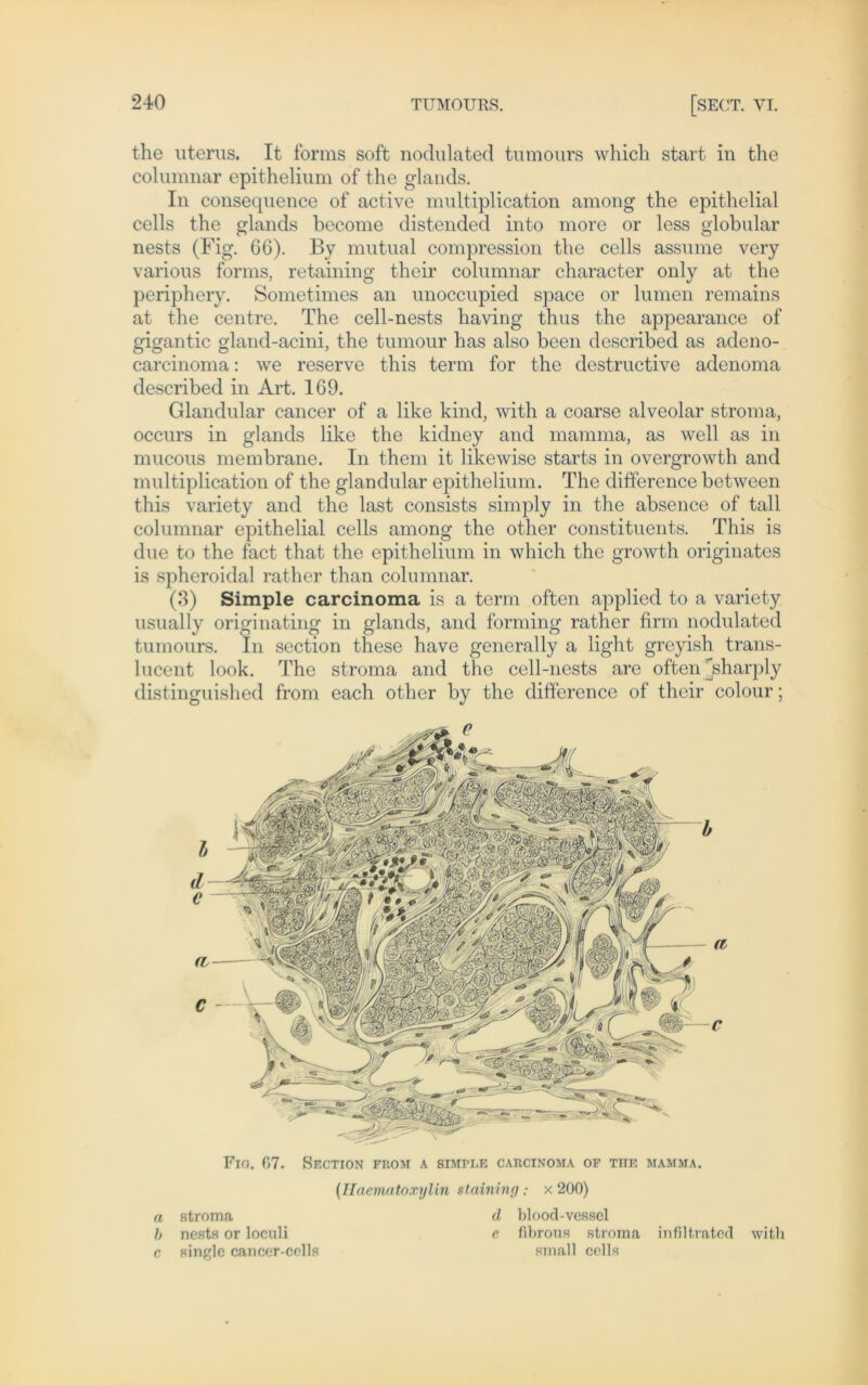 the uterus. It forms soft nodulated tumours which Start in the columnar epithelium of the glands. In consequence of active multiplication among the epithelial cells the glands become distended into more or less globular nests (Fig. 66). By mutual compression the cells assume very various forms, retaining their columnar character only at the periphery. Sometimes an unoccupied space or lumen remains at the centre. The cell-nests having thus the appearance of gigantic gland-acini, the tumour has also been described as adeno- carcinoma: we reserve this term for the destructive adenoma described in Art. 169. Glandular cancer of a like kind, with a coarse alveolar stroma, occurs in glands like the kidney and mamma, as well as in mucous membrane. In them it likewise starts in overgrowth and multiplication of the glandular epithelium. The difference between this variety and the last consists simply in the absence of tall columnar epithelial cells among the other constituents. This is due to the fact that the epithelium in which the growth originates is spheroidal rather than columnar. (3) Simple carcinoma is a term often applied to a variety usually originating in glands, and forming ratlicr firm nodulated tumours. In section these have gencrally a light greyish trans- lucent look. The stroma and the cell-nests are often ^sharply distinguished from each other by the difference of their colour; Fio. 07. Section from a simple carcinoma of tue mamma. (Ilaematoxylin staining .* x200) a stroma d blood-vesscl h nests or loculi e fibrons stroma infiltrated with c single cancer-cells small cells