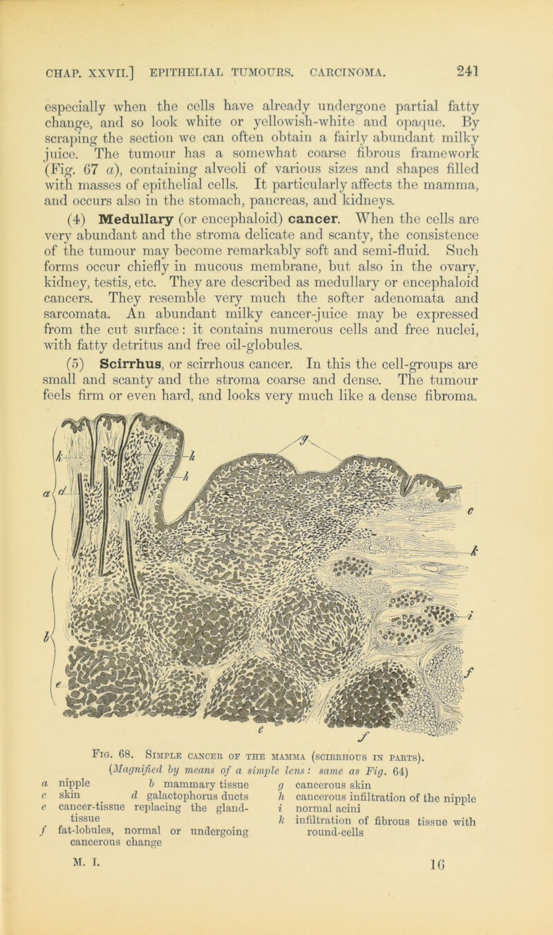 especially when the cells have already undergone partial fatty change, and so look white or yellowish-white and opaque. By scraping the section we can often obtain a fairly abundant milky Juice. The tumour has a somewhat coarse fibrous framework (Fig. 67 ci), containing alveoli of various sizes and shapes filled with masses of epithelial cells. It particularly affects the mamma, and occurs also in the stomach, pancreas, and kidneys. (4) Medullary (or encephaloid) cancer. When the cells are very abundant and the stroma delicate and scanty, the consistence of the tumour may become remarkably soft and semi-fluid. Such forms occur chiefly in mucous membrane, but also in the ovary, kidney, testis, etc. They are described as medullary or encephaloid cancers. They resemble very much the softer adenomata and sarcomata. An abundant milky cancer-juice may be expressed from the cut surface: it contains numerous cells and free nuclei, with fatty detritus and free oil-globules. (5) Scirrhus, or scirrhous cancer. In this the cell-groups are small and scanty and the stroma coarse and dense. The tumour feels firm or even hard, and looks very much like a dense fibroma. Fig. 68. Simple cancer of the mamma (scirrhous in parts). (Magnified by means of a simple lens .* same as Fig. 64) cancerous skin caucerous iufiltration of the nipple a nipple b mammary tissue c skin d galactophorus ducts e cancer-tissue replacing the gland- tissue f fat-lobules, normal or undergoing cancerous change 0 h i k normal acini iufiltration of fibrous tissue with round-cells M. I. 10